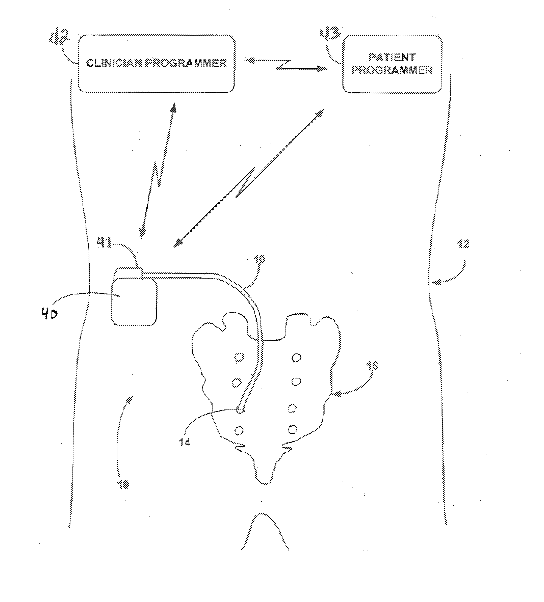 Implantable Medical Electrical Stimulation Lead Fixation Method and Apparatus