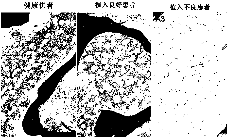 A kit, a system and a method for determining patient marrow microenvironment after hematopoietic stem cell transplantation