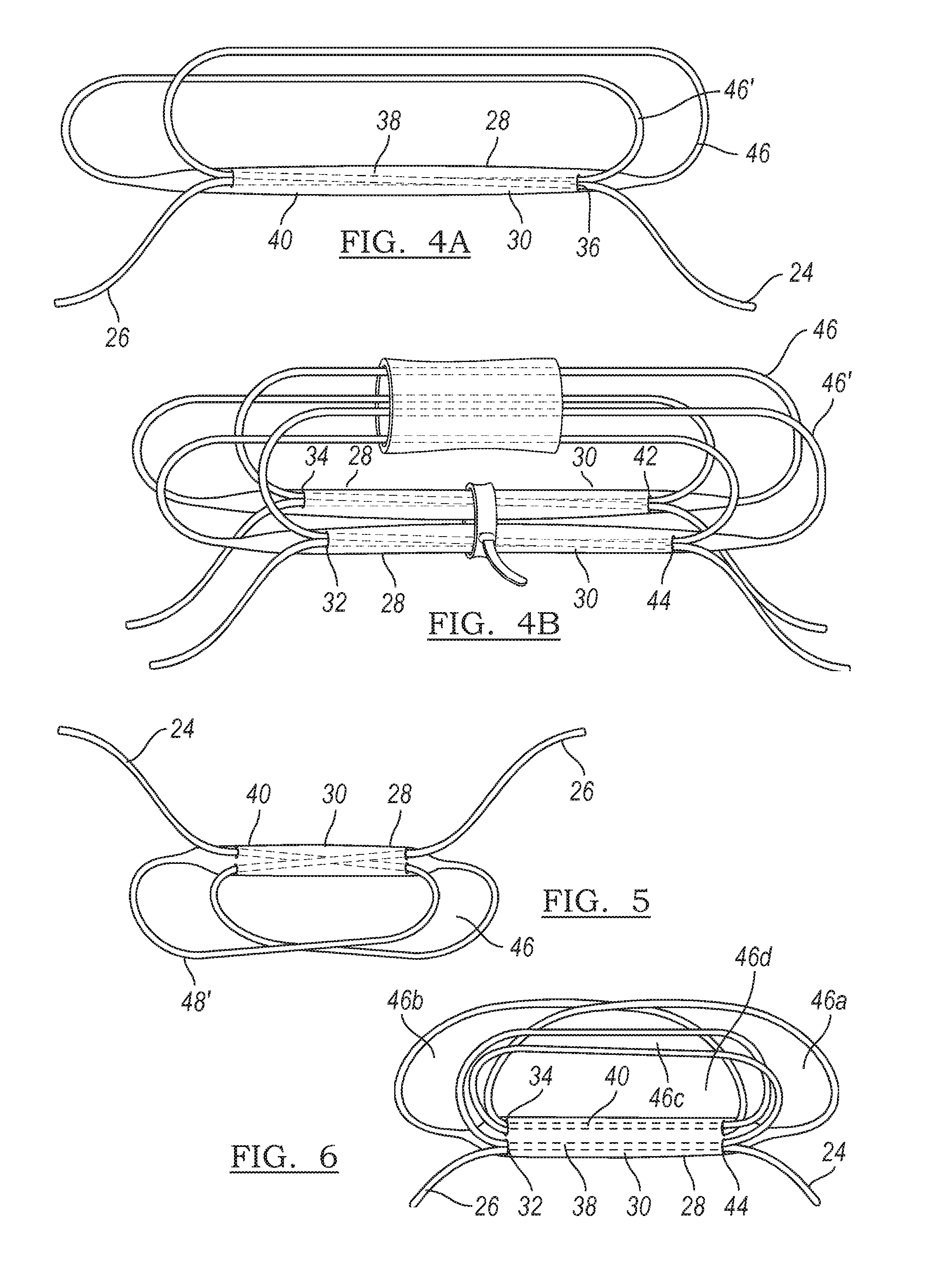 Method and apparatus for coupling anatomical features