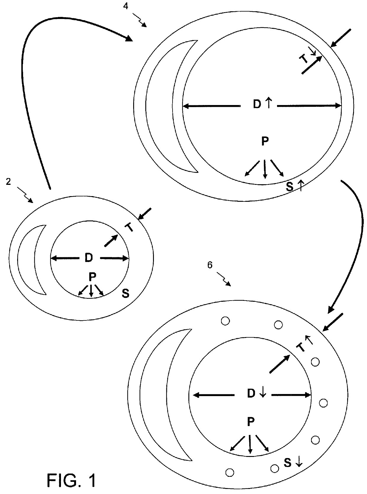 Intramyocardial patterning for global cardiac resizing and reshaping