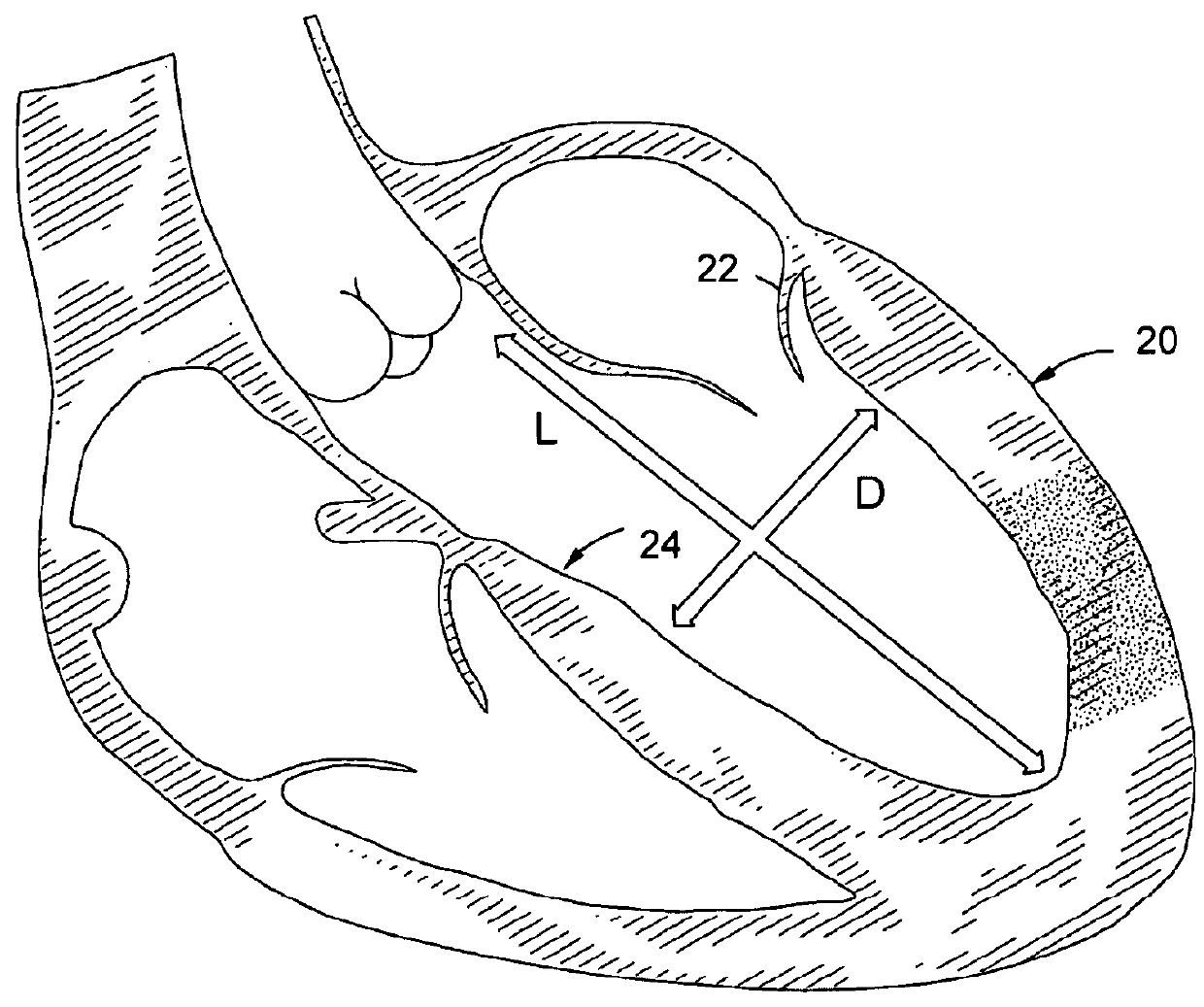 Intramyocardial patterning for global cardiac resizing and reshaping