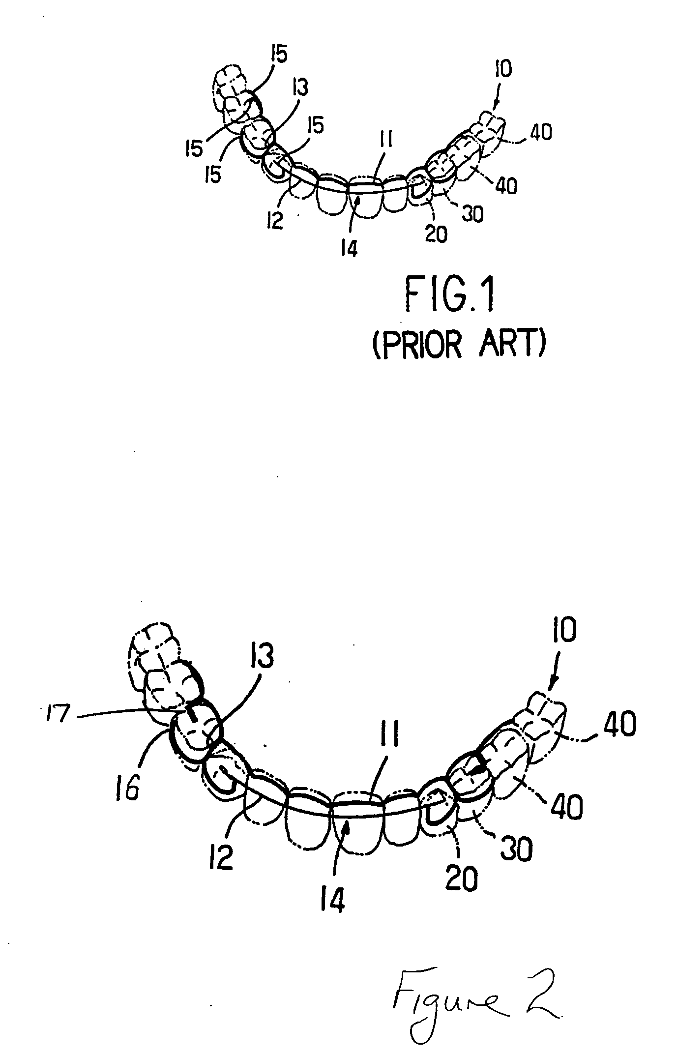 Orthodontic wire retainer