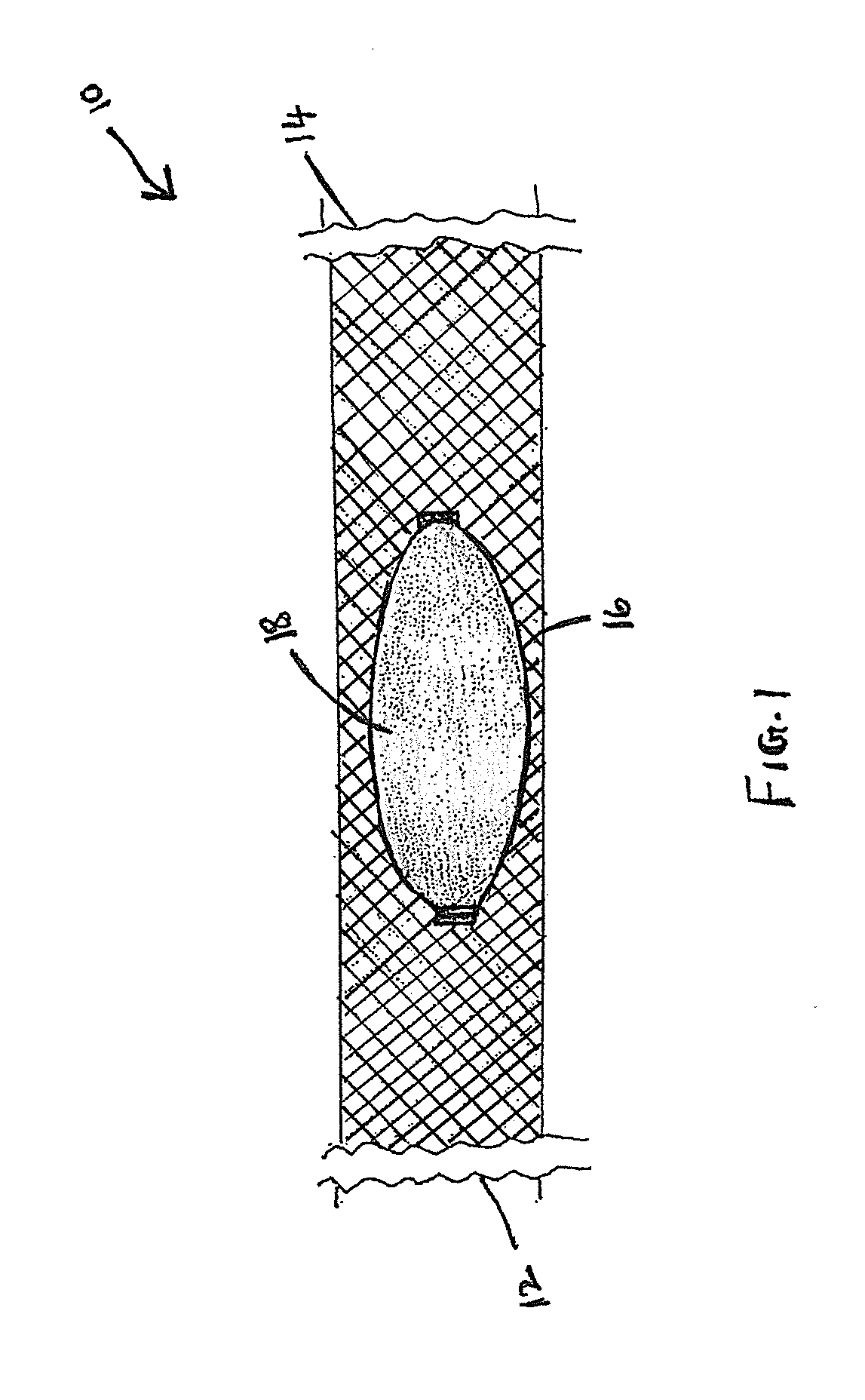 Photo-Activatable Gel Coated Intracranial Stent and Embolic Coil