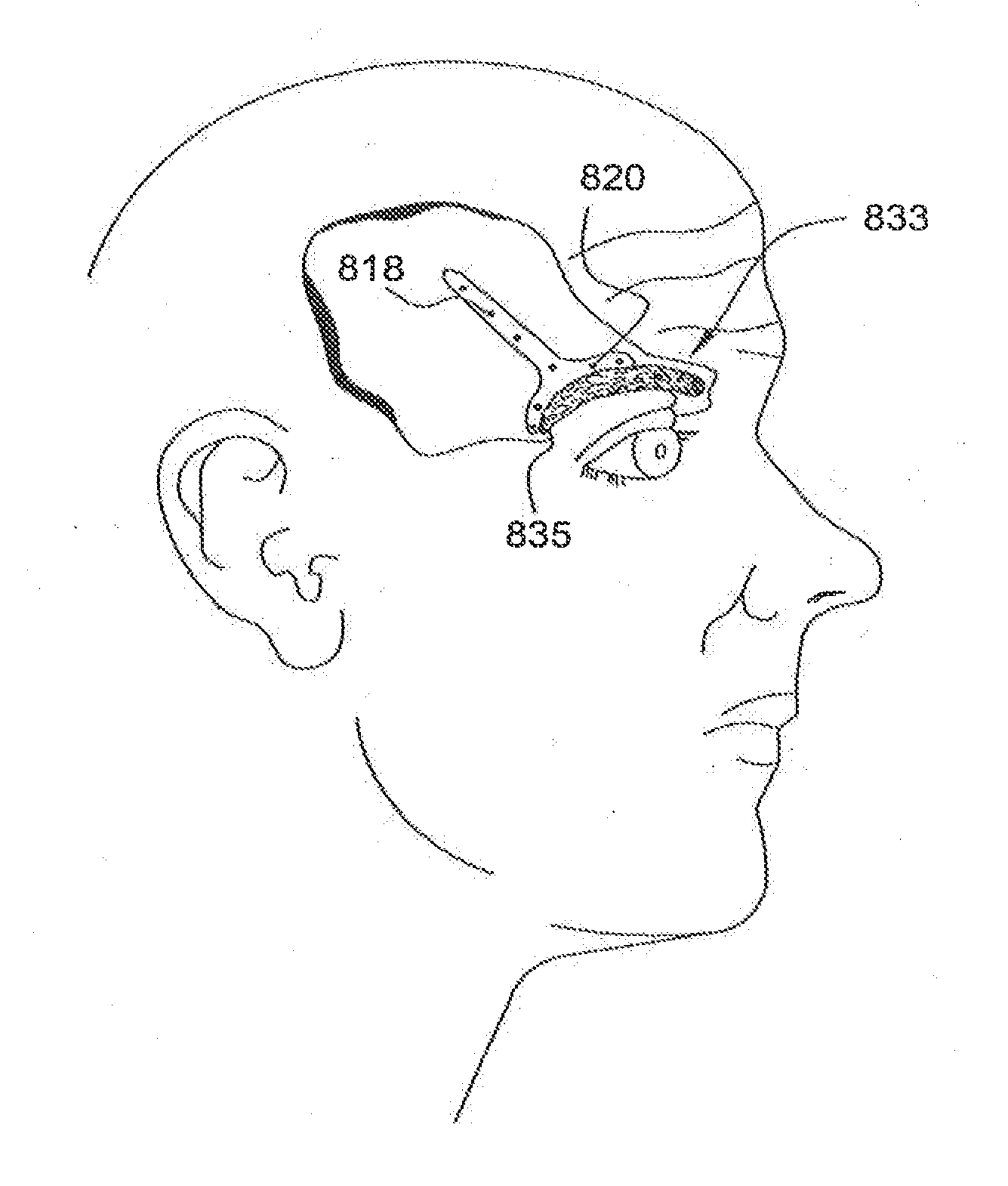 Temporal brow lifting and fixation device