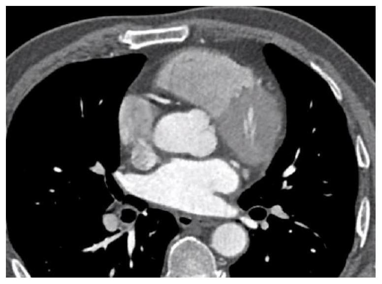 Coronary artery origin abnormity judgment method and device