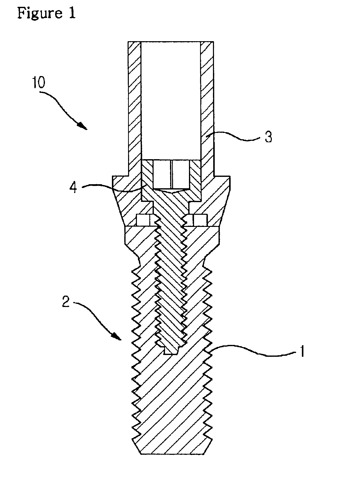 Dental implant structure