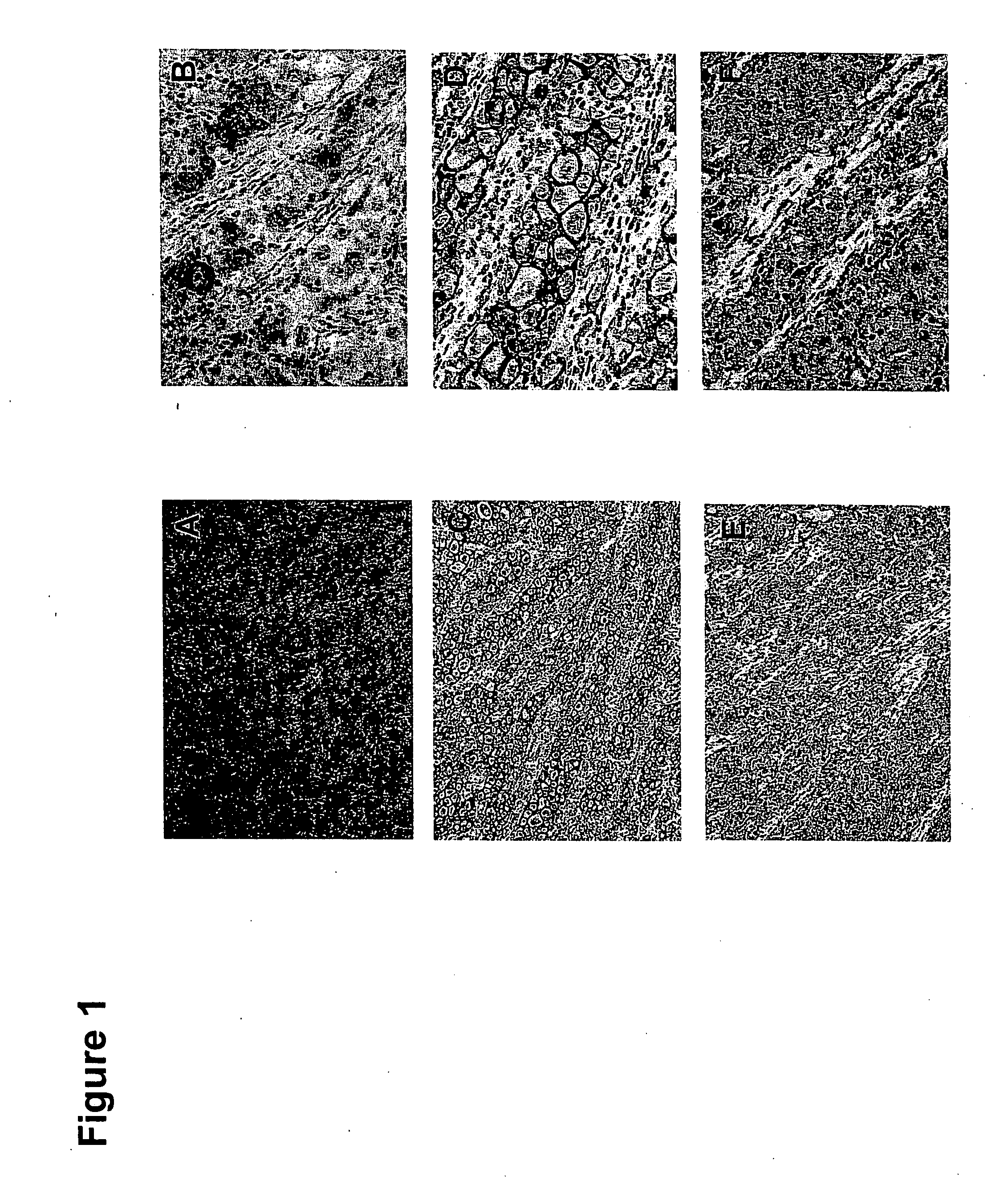 Utility of high molecular weight melanoma associated antigen in diagnosis and treatment of cancer