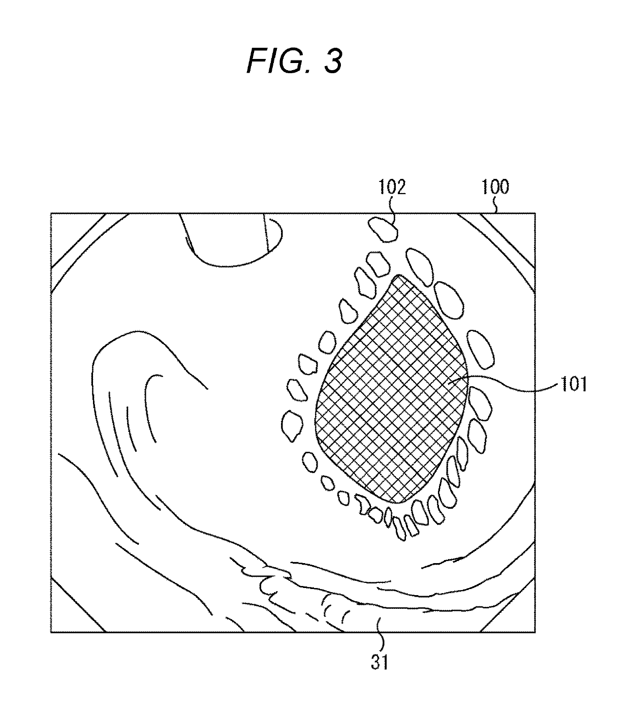 Device, method, and system for image guided surgical resection