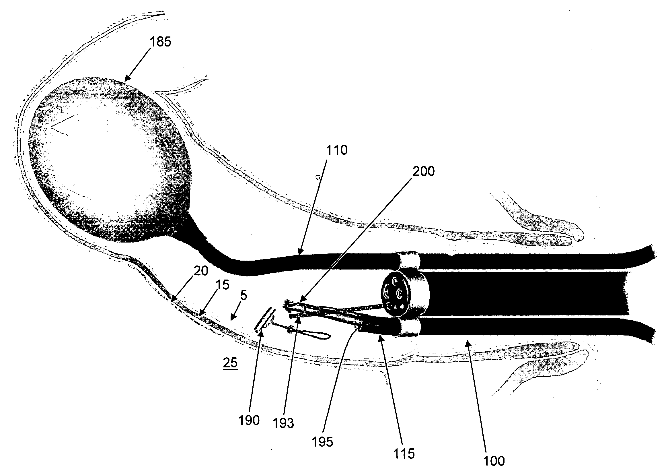 Method and apparatus for endoscopically treating rectal prolapse