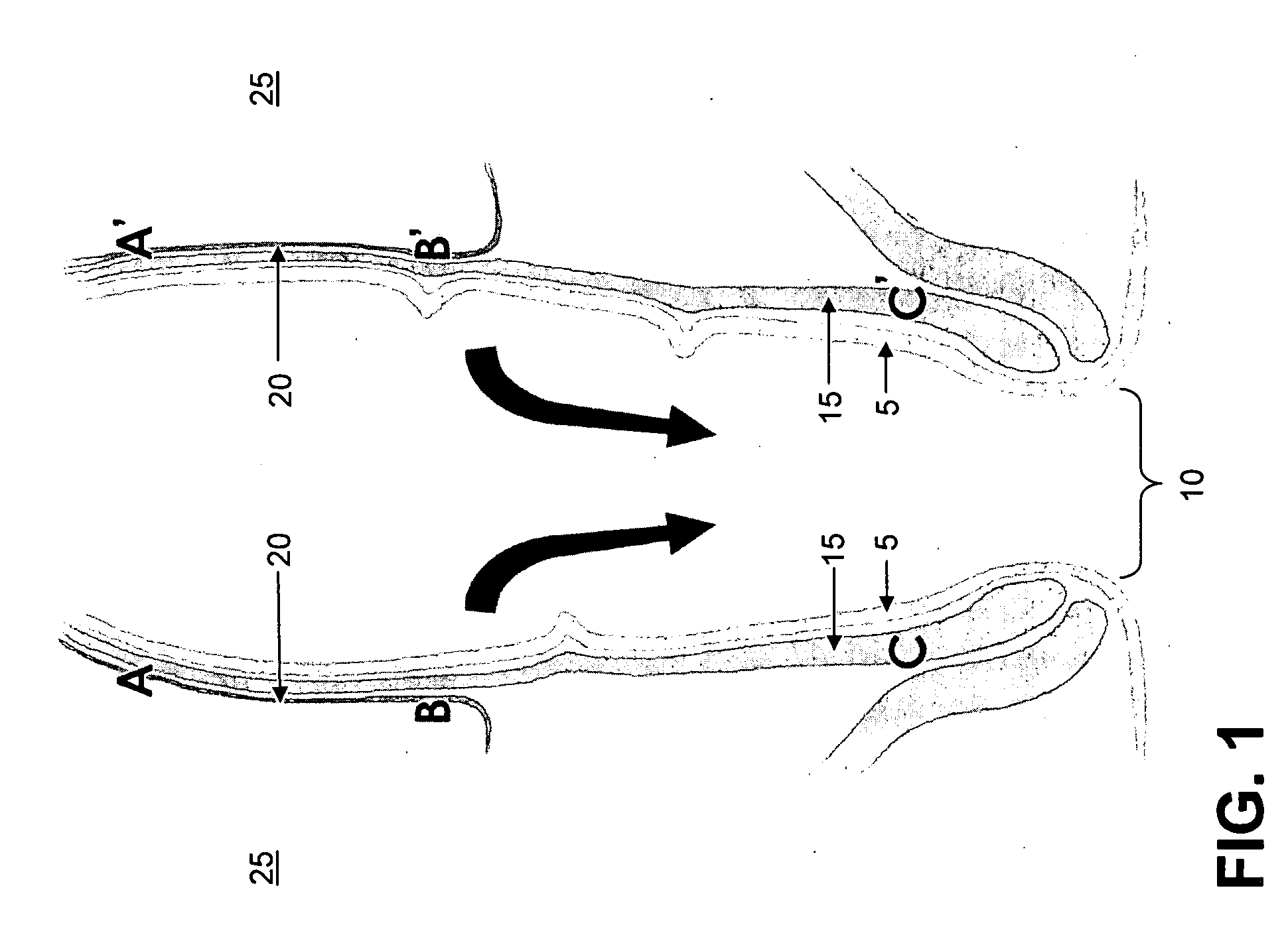 Method and apparatus for endoscopically treating rectal prolapse