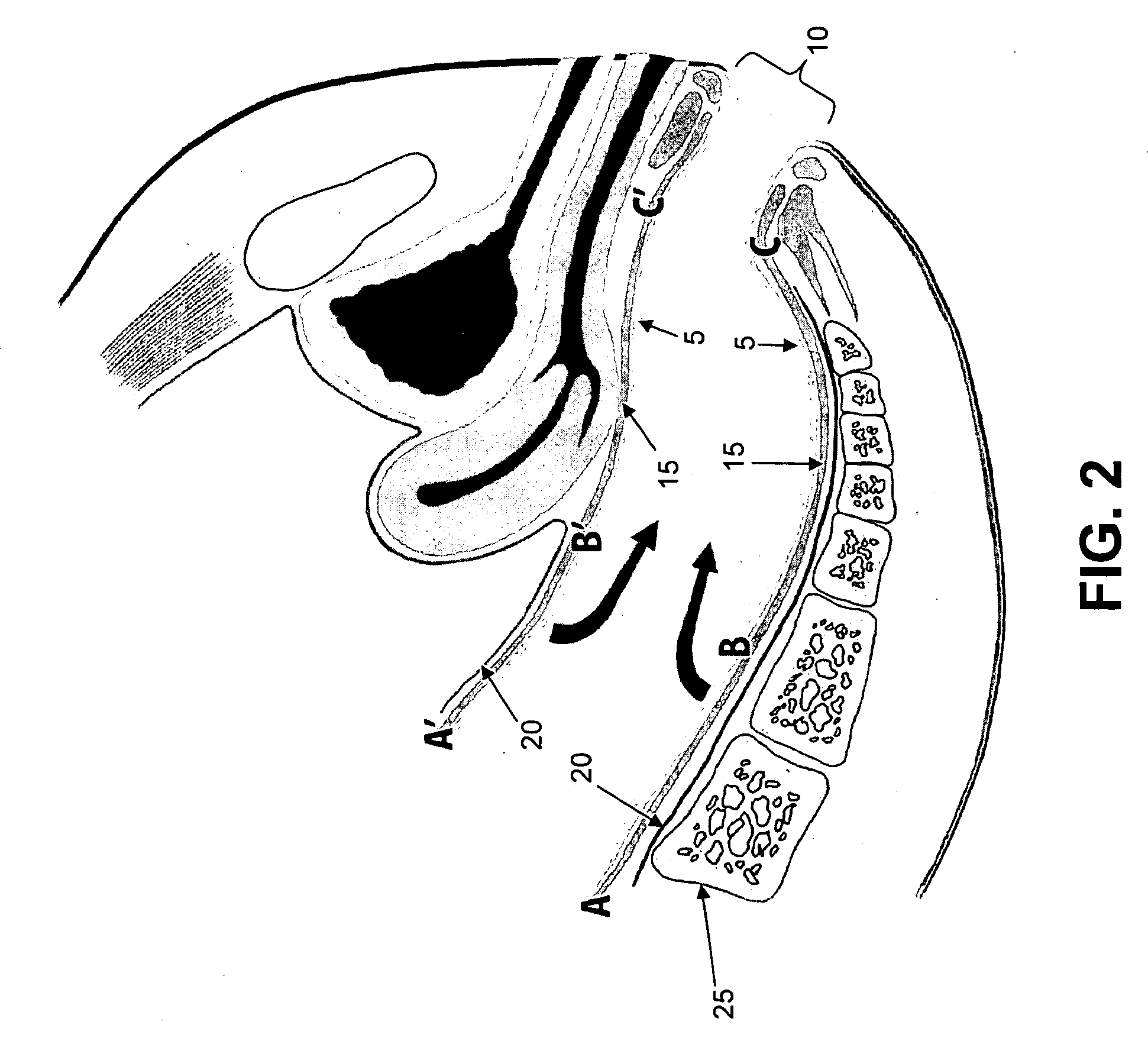 Method and apparatus for endoscopically treating rectal prolapse