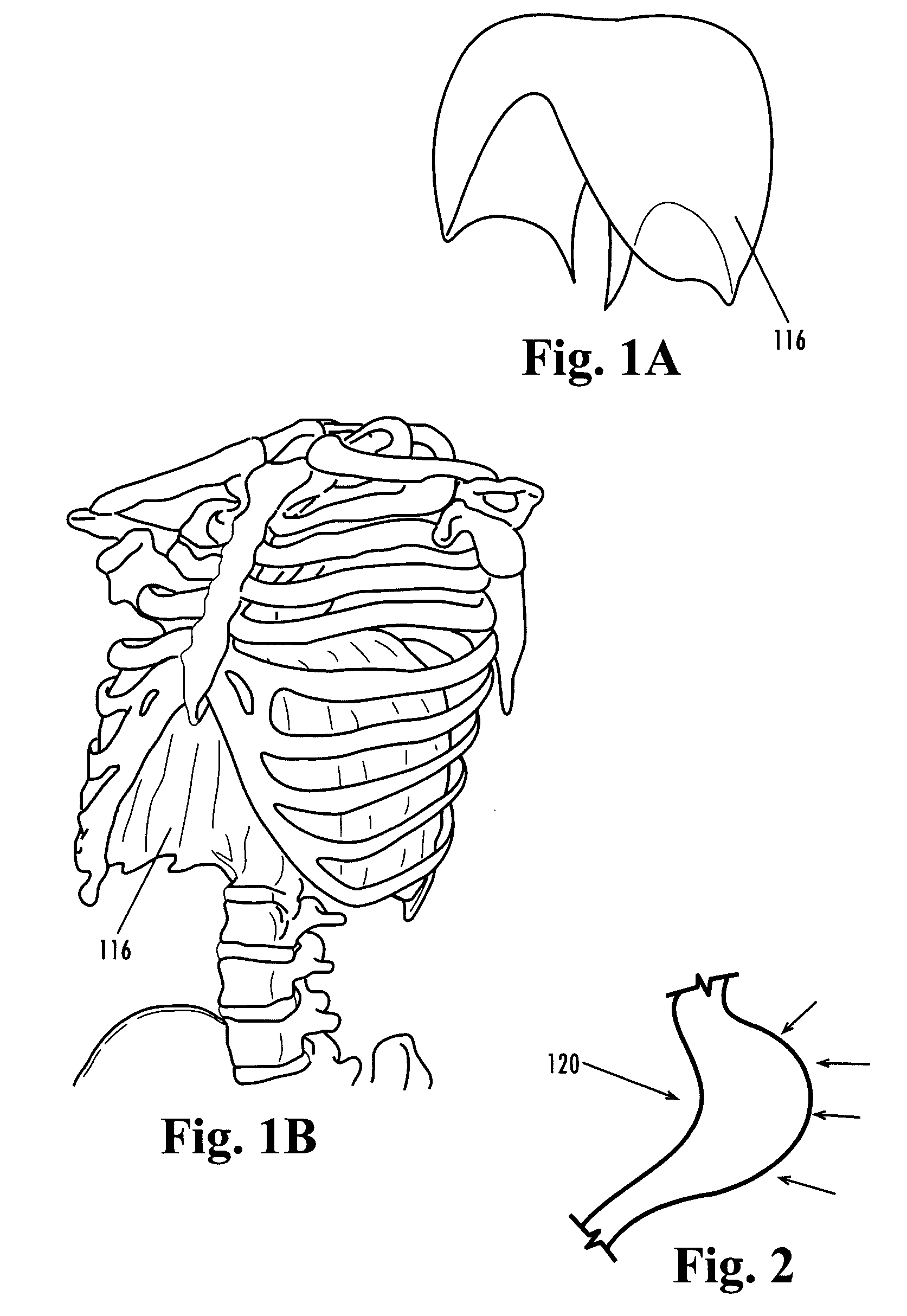 Devices and methods for treatment of obesity