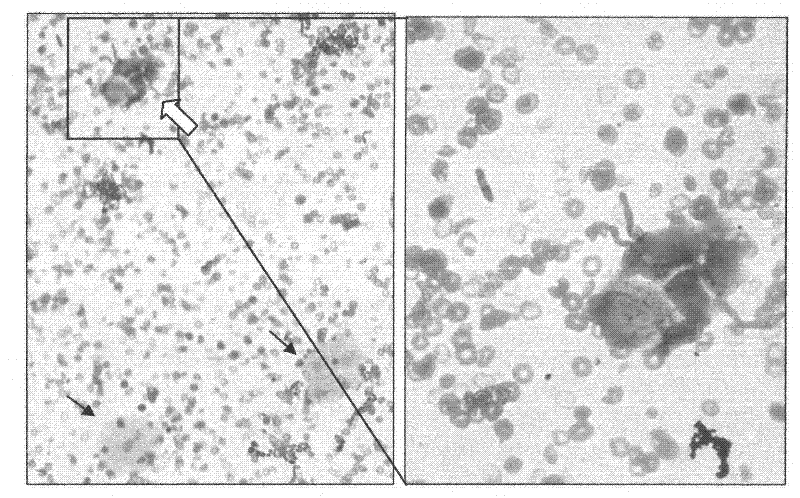 Enzyme-labeling-liquid-based cytology staining kit for screening bladder cancer