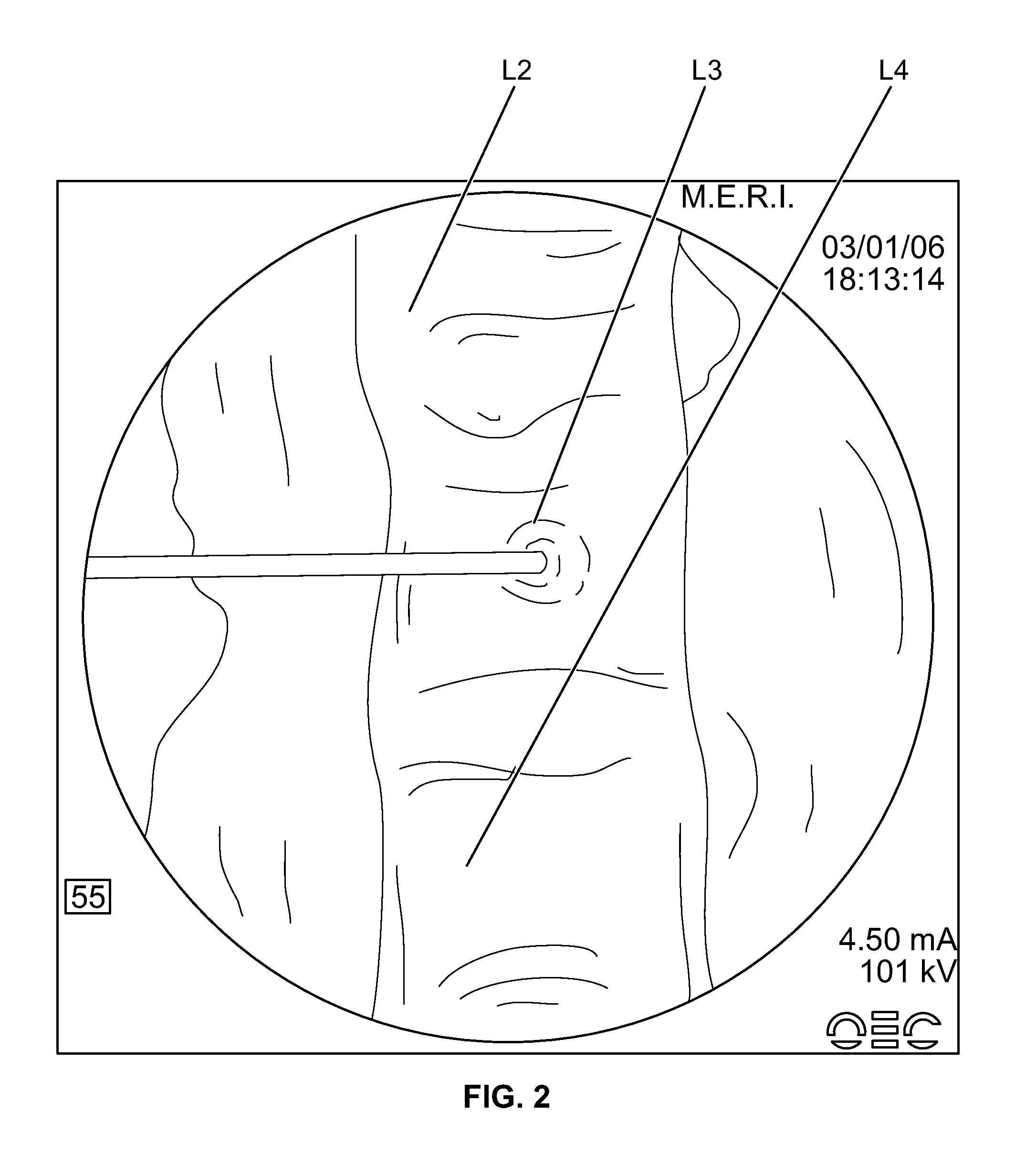 Compositions and methods for treating the vertebral column