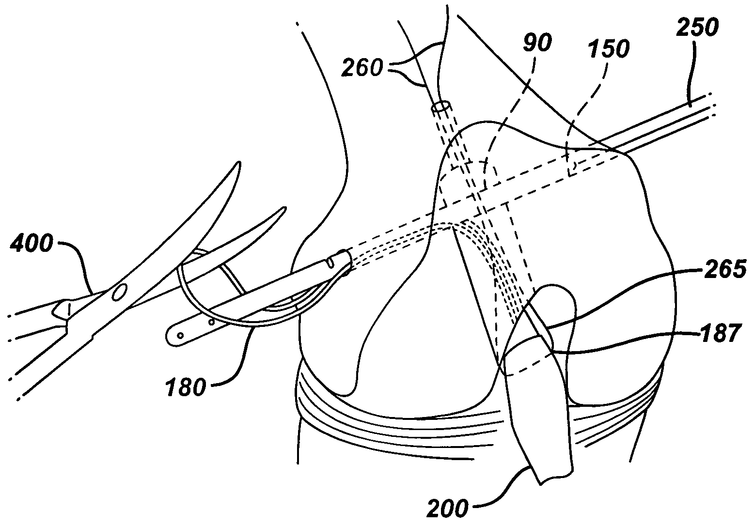 Method of replacing an anterior cruciate ligament in the knee