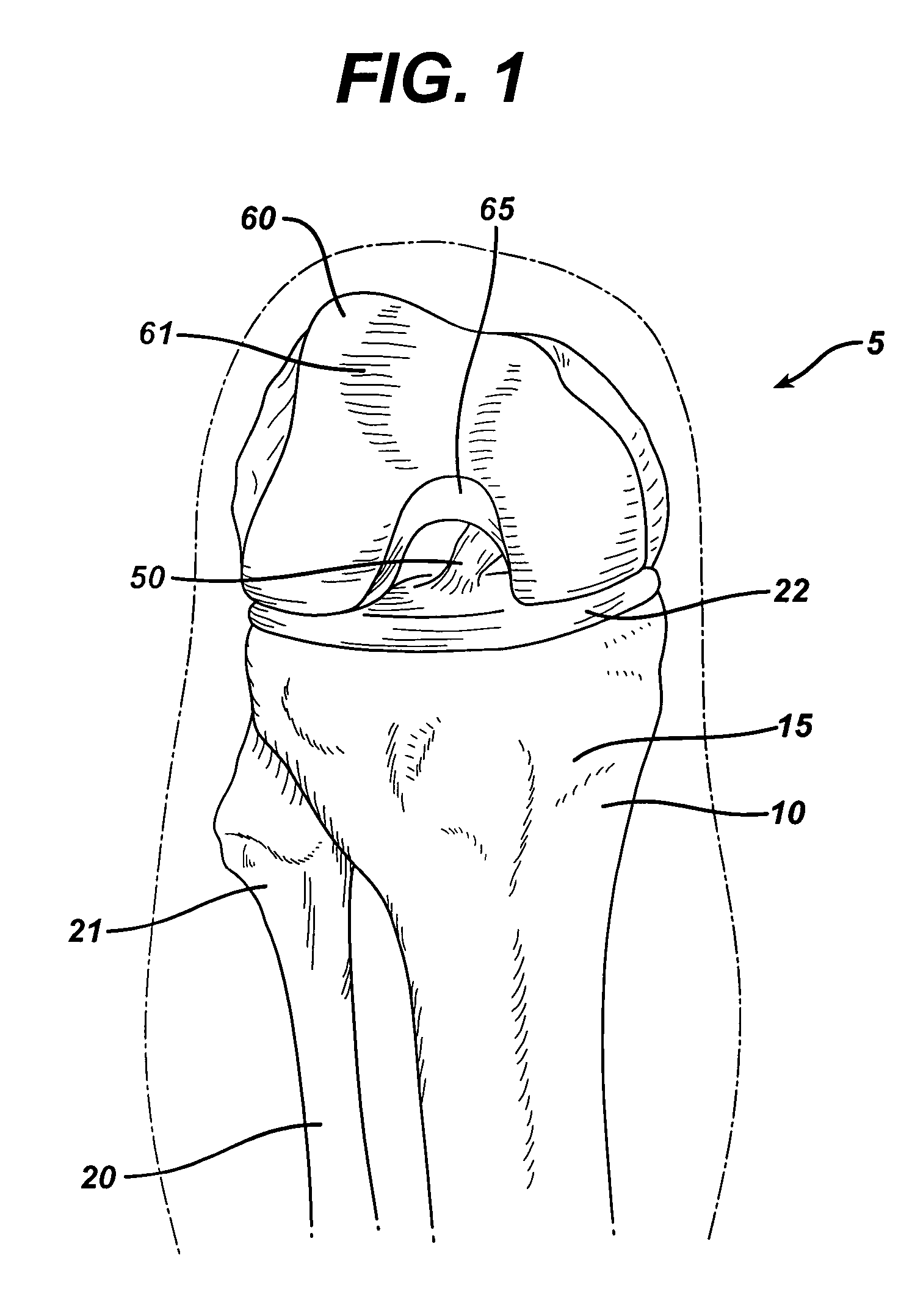 Method of replacing an anterior cruciate ligament in the knee