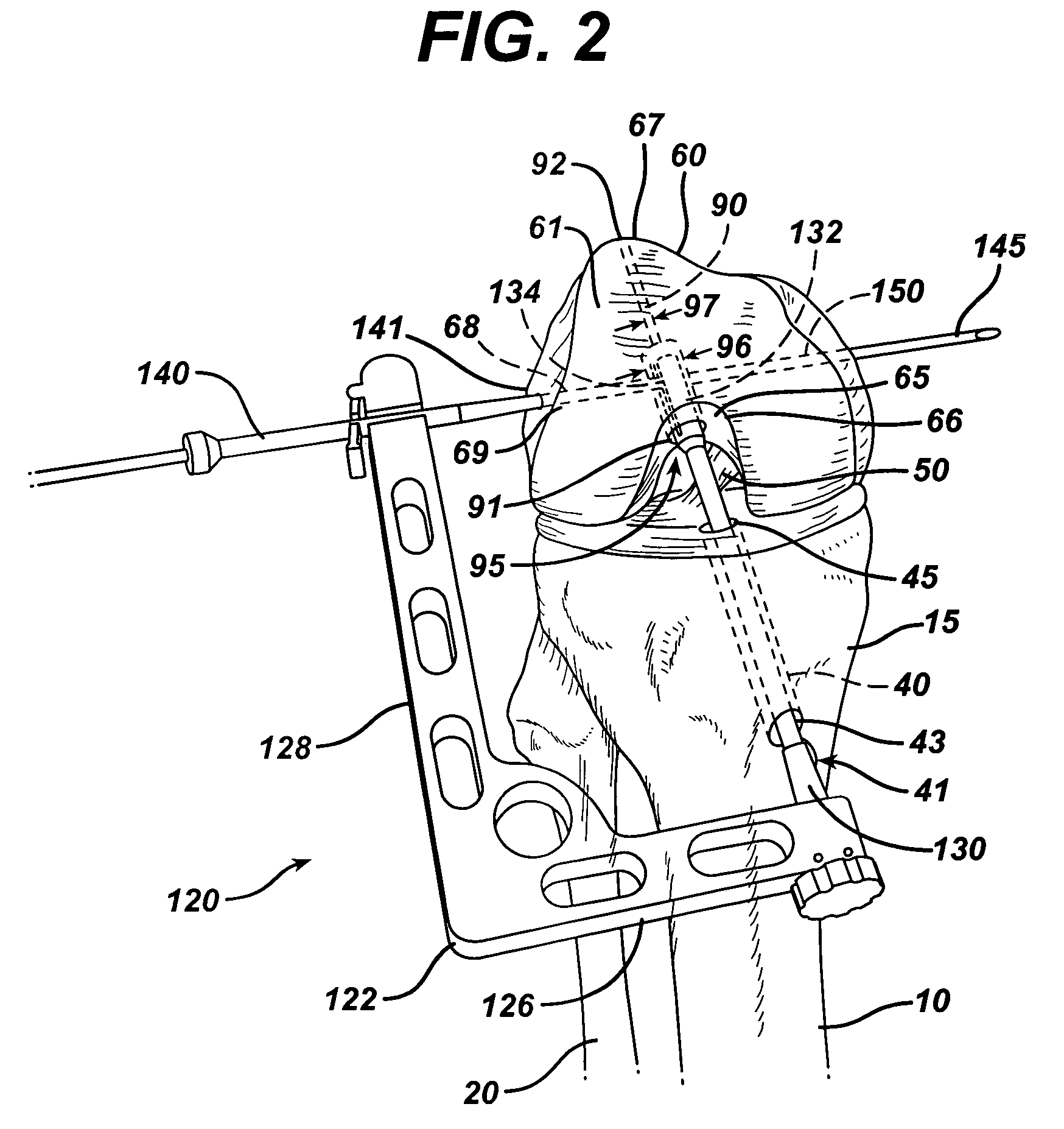 Method of replacing an anterior cruciate ligament in the knee