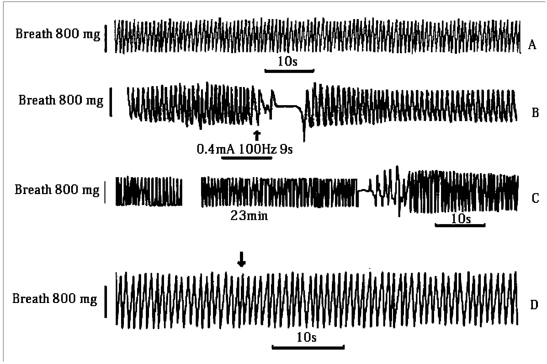 Application of high-frequency current for treating OSA