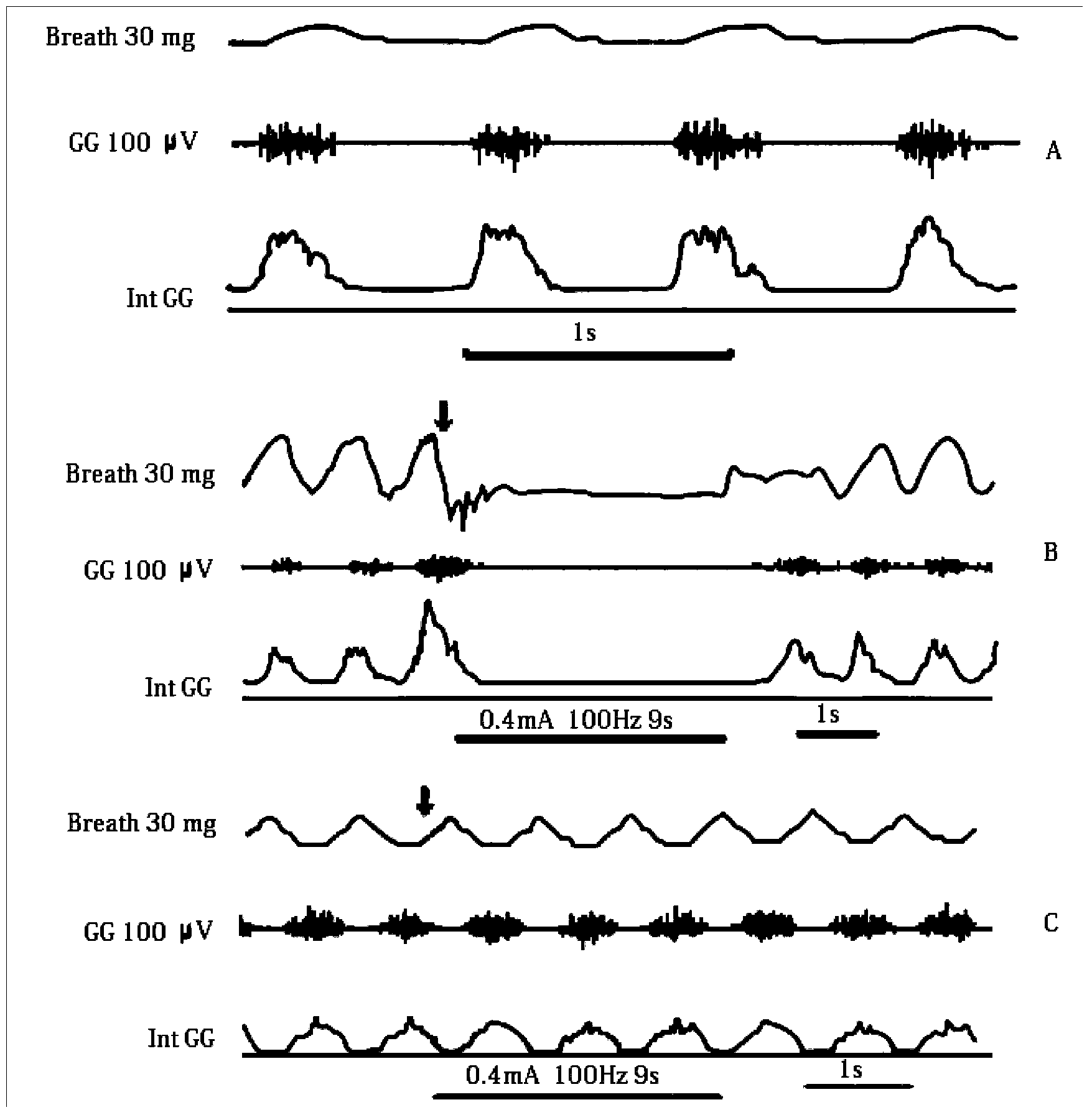 Application of high-frequency current for treating OSA