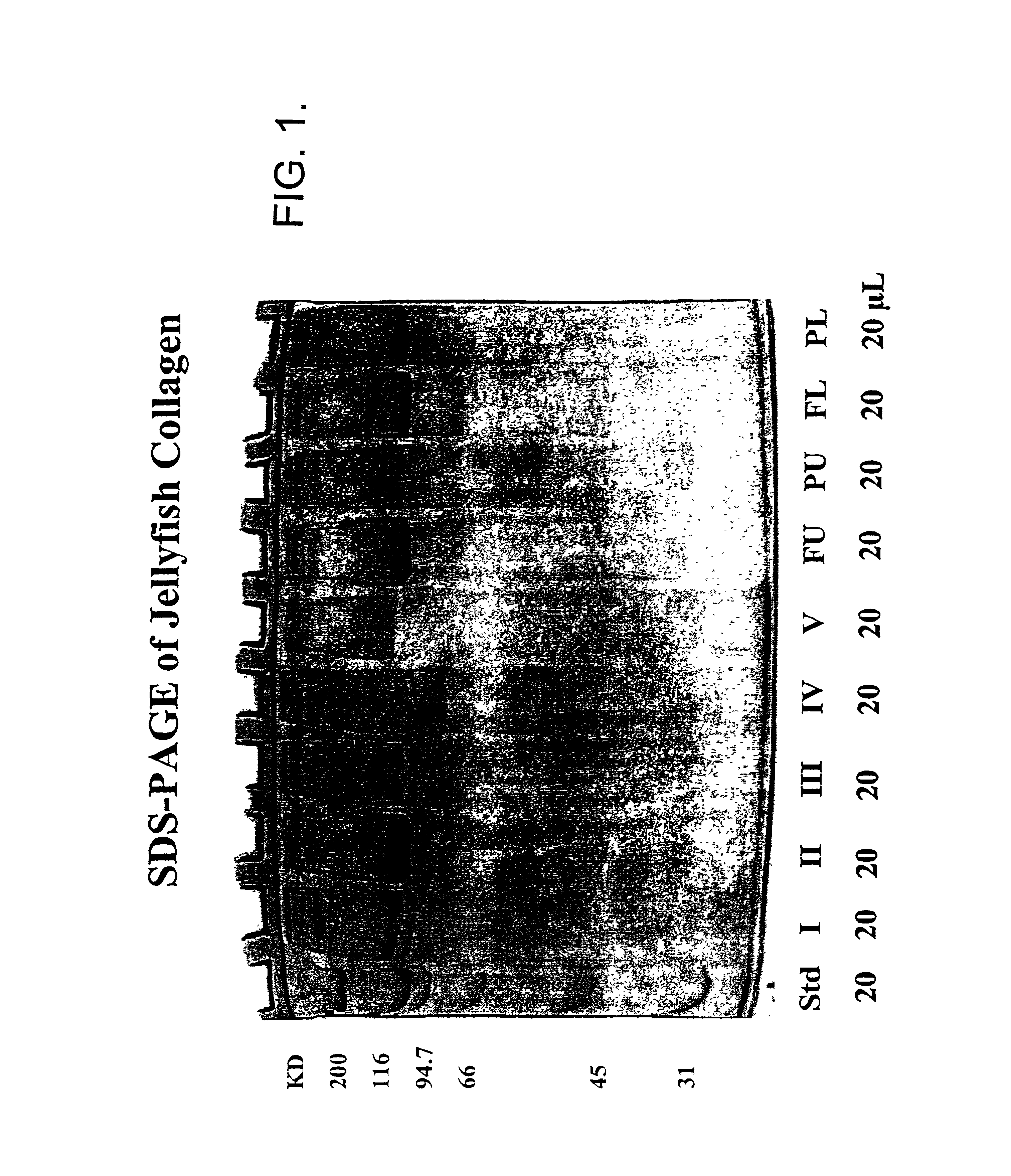 Use of jellyfish collagen (type II) in the treatment of rheumatoid arthritis