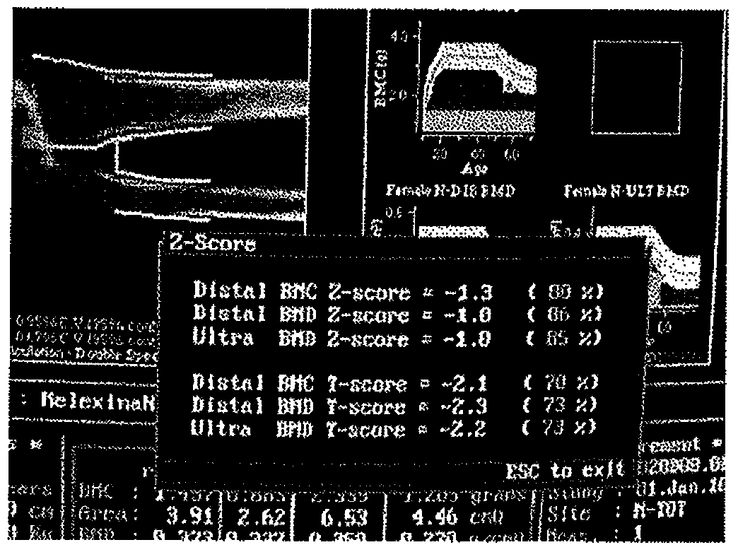 Method for diagnosing osteoporosis by a method for defining the dynamics of closing cavity formations in order to assess the effectiveness of using various osteoprotectors