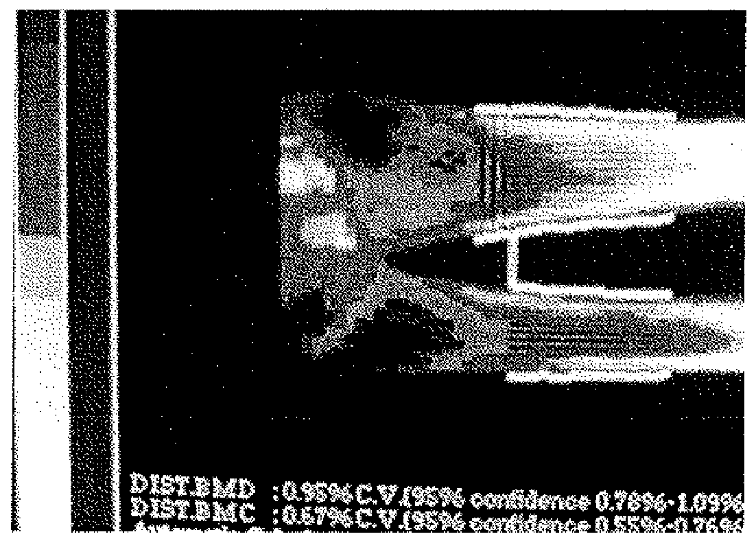 Method for diagnosing osteoporosis by a method for defining the dynamics of closing cavity formations in order to assess the effectiveness of using various osteoprotectors