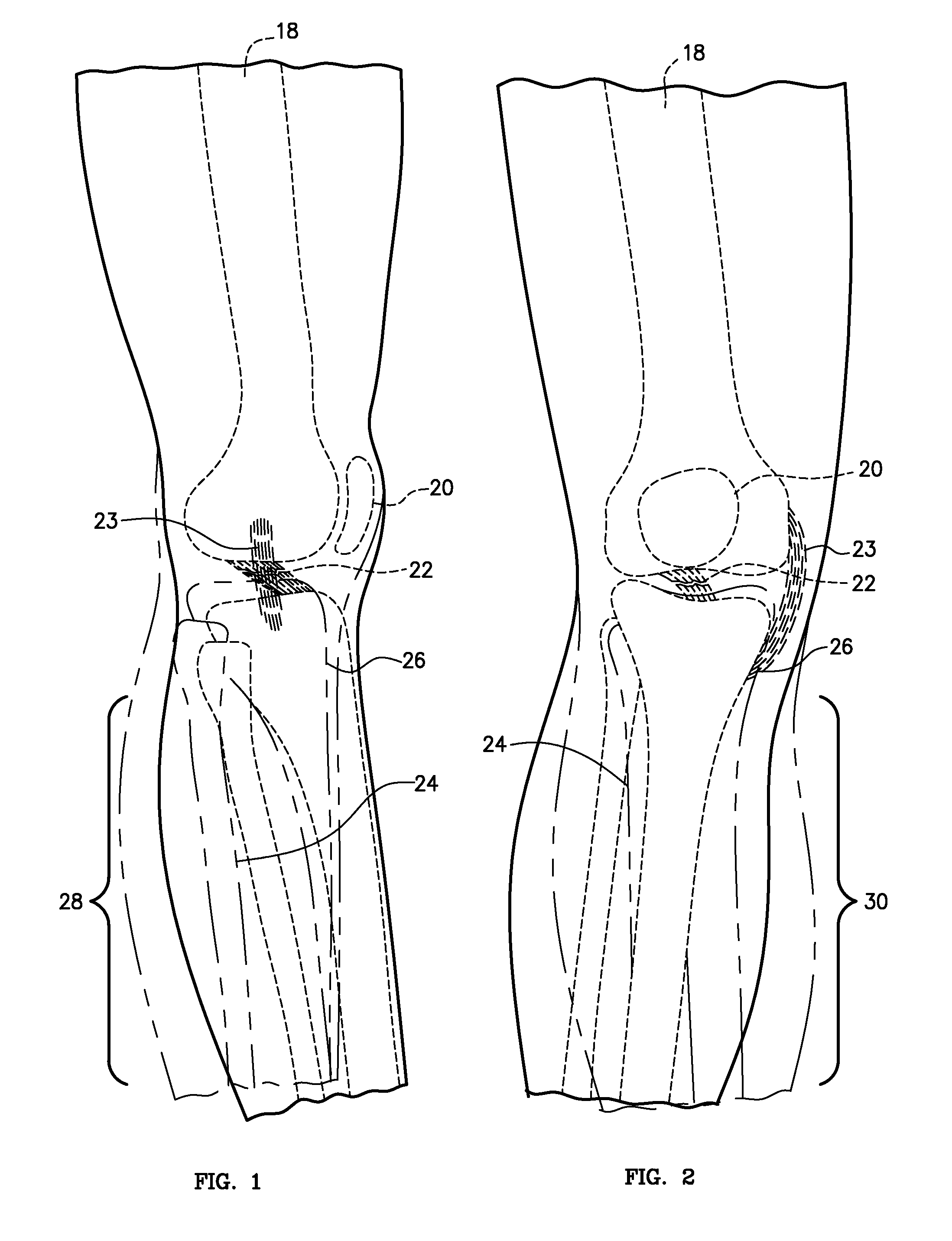 Cable Knee Brace System