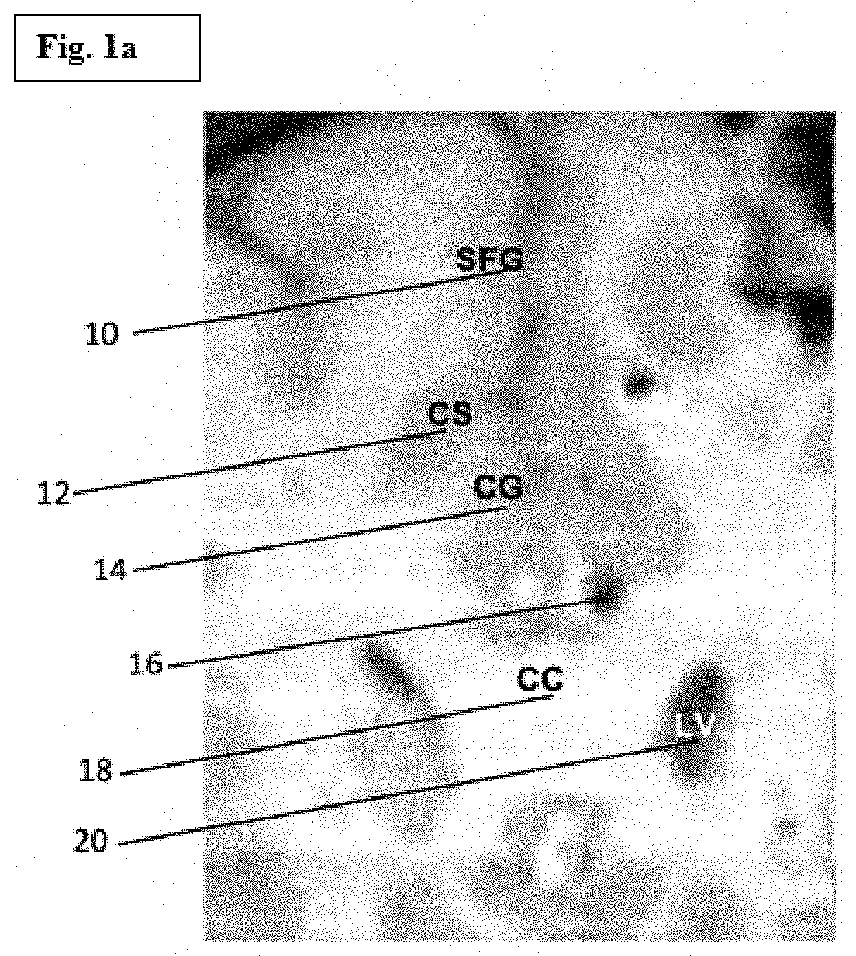 Anxiolysis without sedation: awake craniotomy facilitated by continuous direct stimulation of cingulum bundle