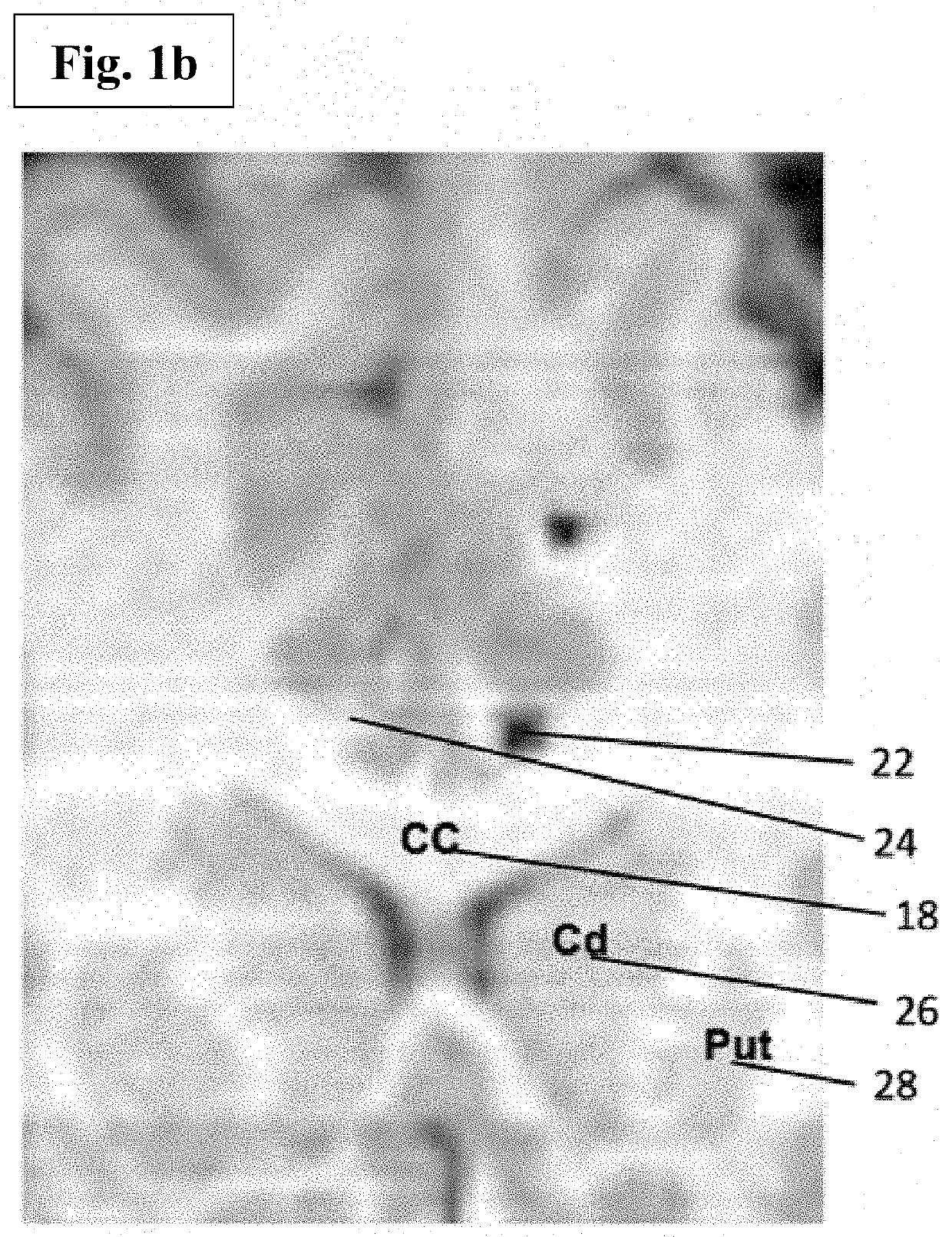 Anxiolysis without sedation: awake craniotomy facilitated by continuous direct stimulation of cingulum bundle