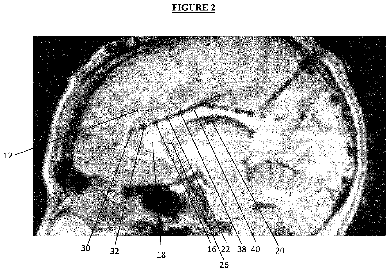 Anxiolysis without sedation: awake craniotomy facilitated by continuous direct stimulation of cingulum bundle