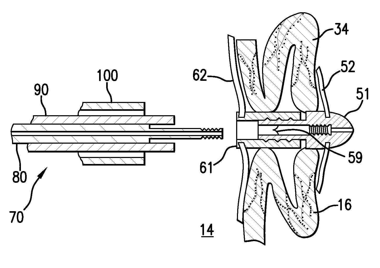 Apparatus And Methods For Excluding The Left Atrial Appendage