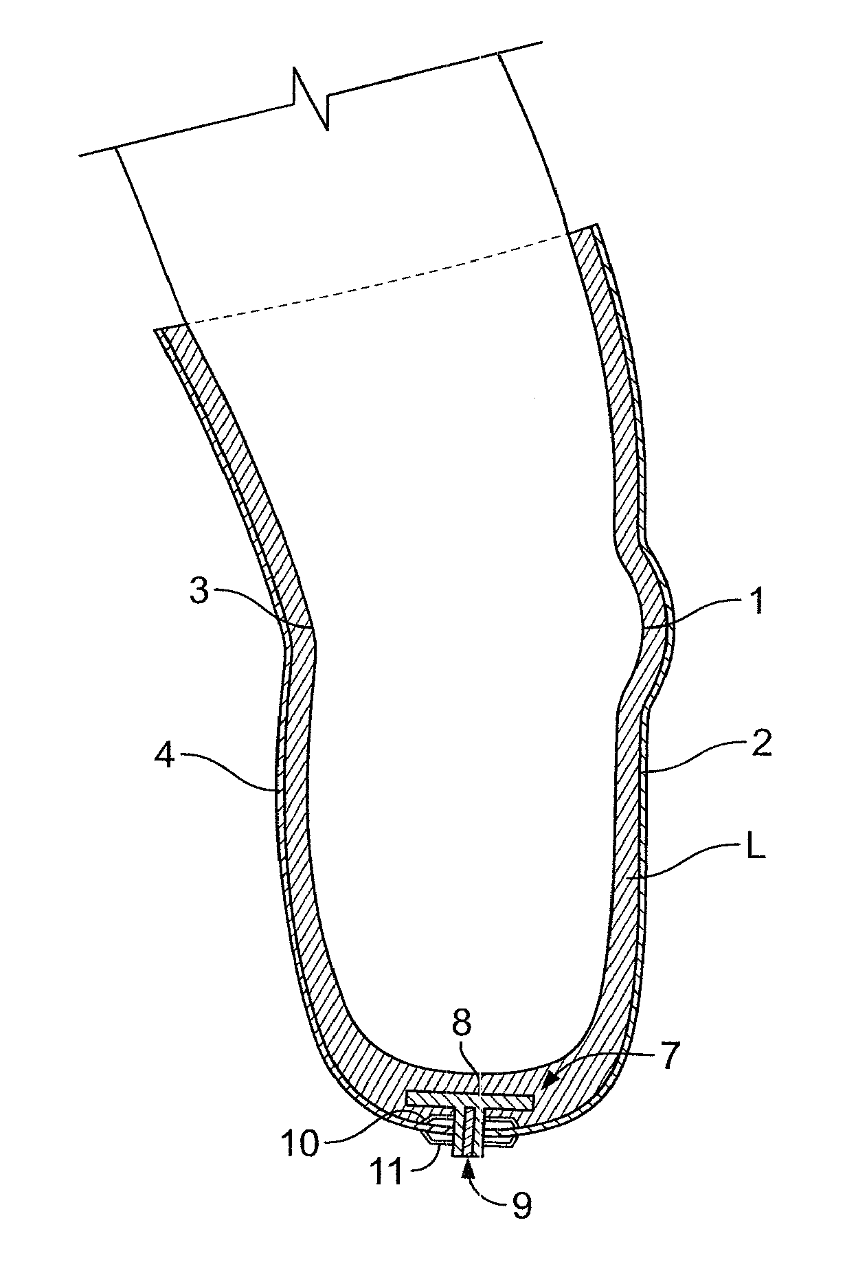 Prosthetic Locking Liner With Improved Knee Flexion