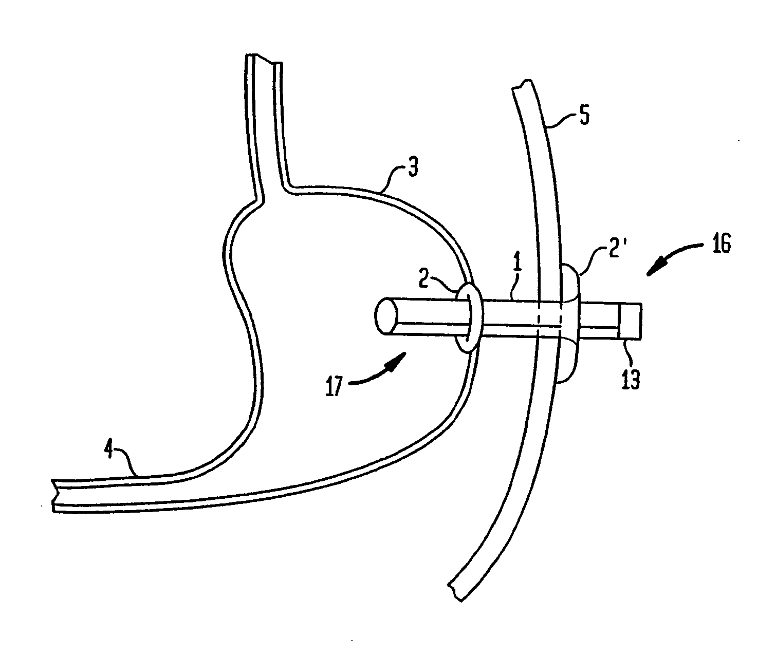 Apparatus for treating obesity by extracting food