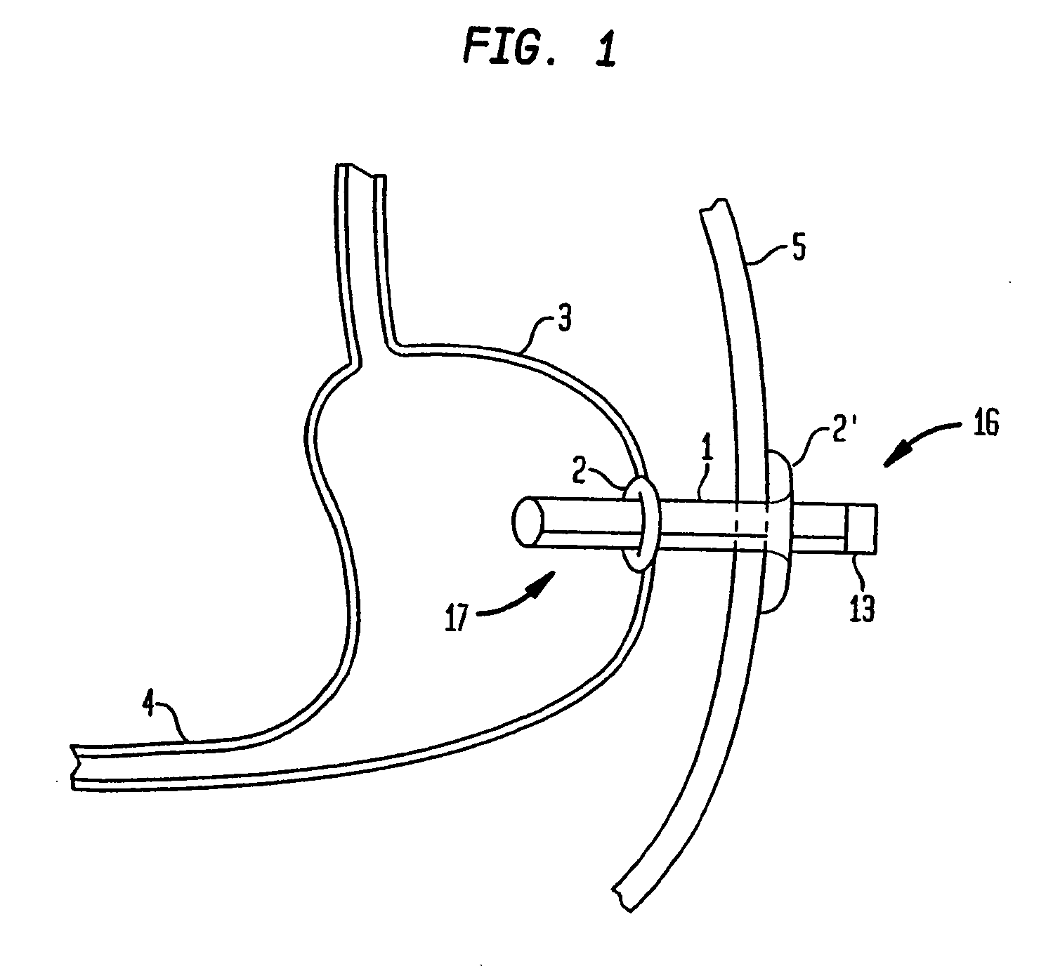 Apparatus for treating obesity by extracting food