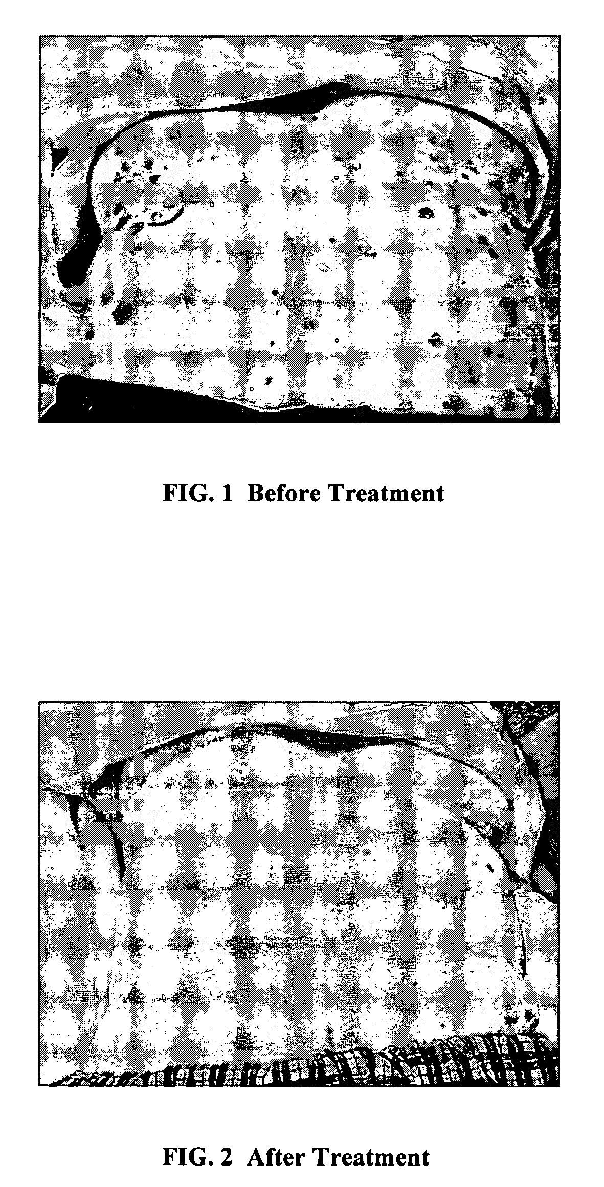 Seborrheic keratosis treatment