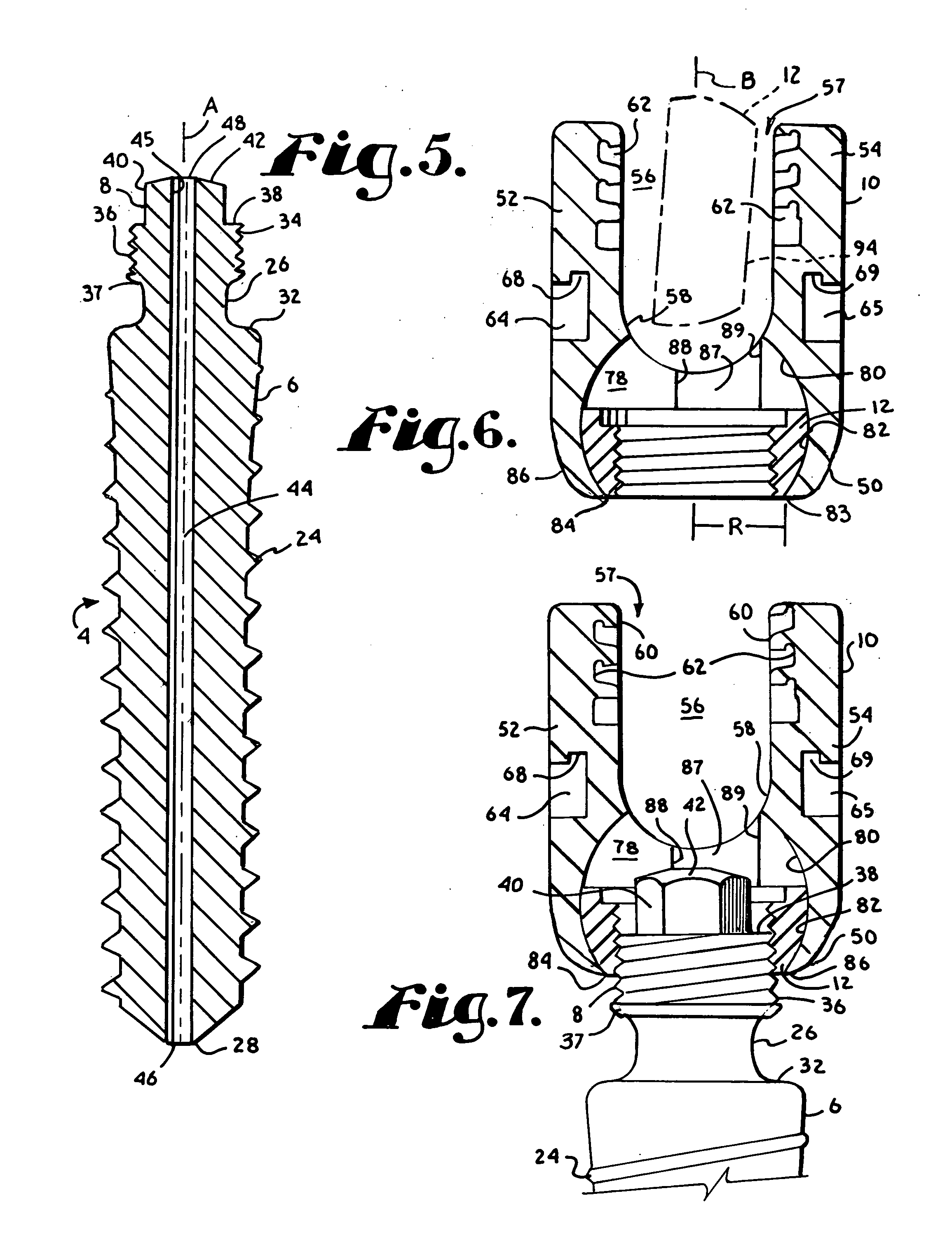 Polyaxial bone screw with helically wound capture connection