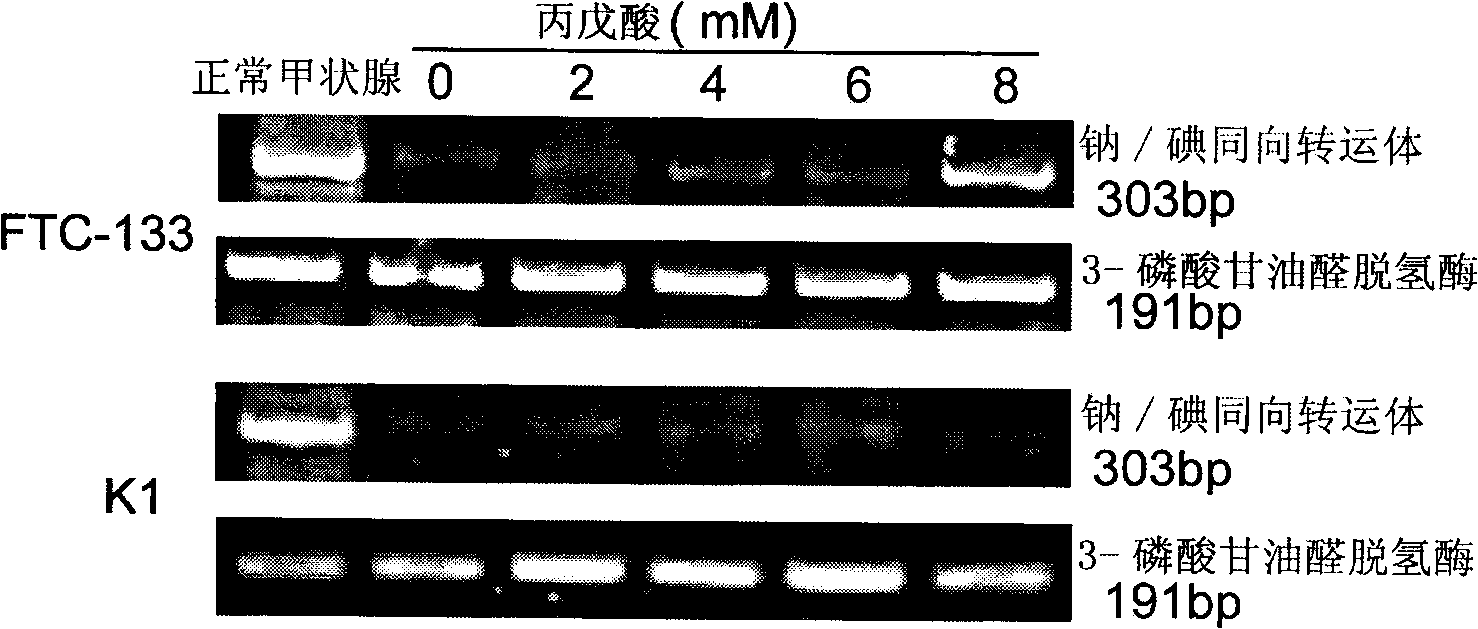 Application of valproate and salt-induced redifferentiation combined with &lt;131&gt; iodine thereof in treating poor differentiation/dedifferentiation thyroid cancer