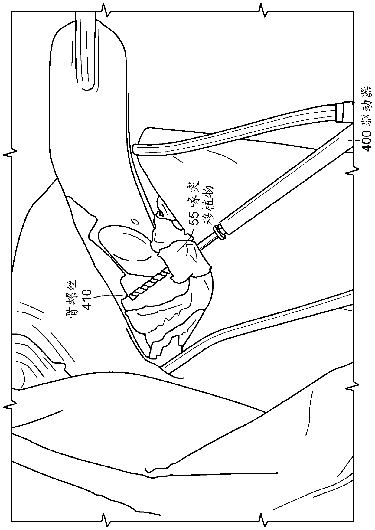 Open LATARJET for correction of anterior-inferior glenoid bone loss