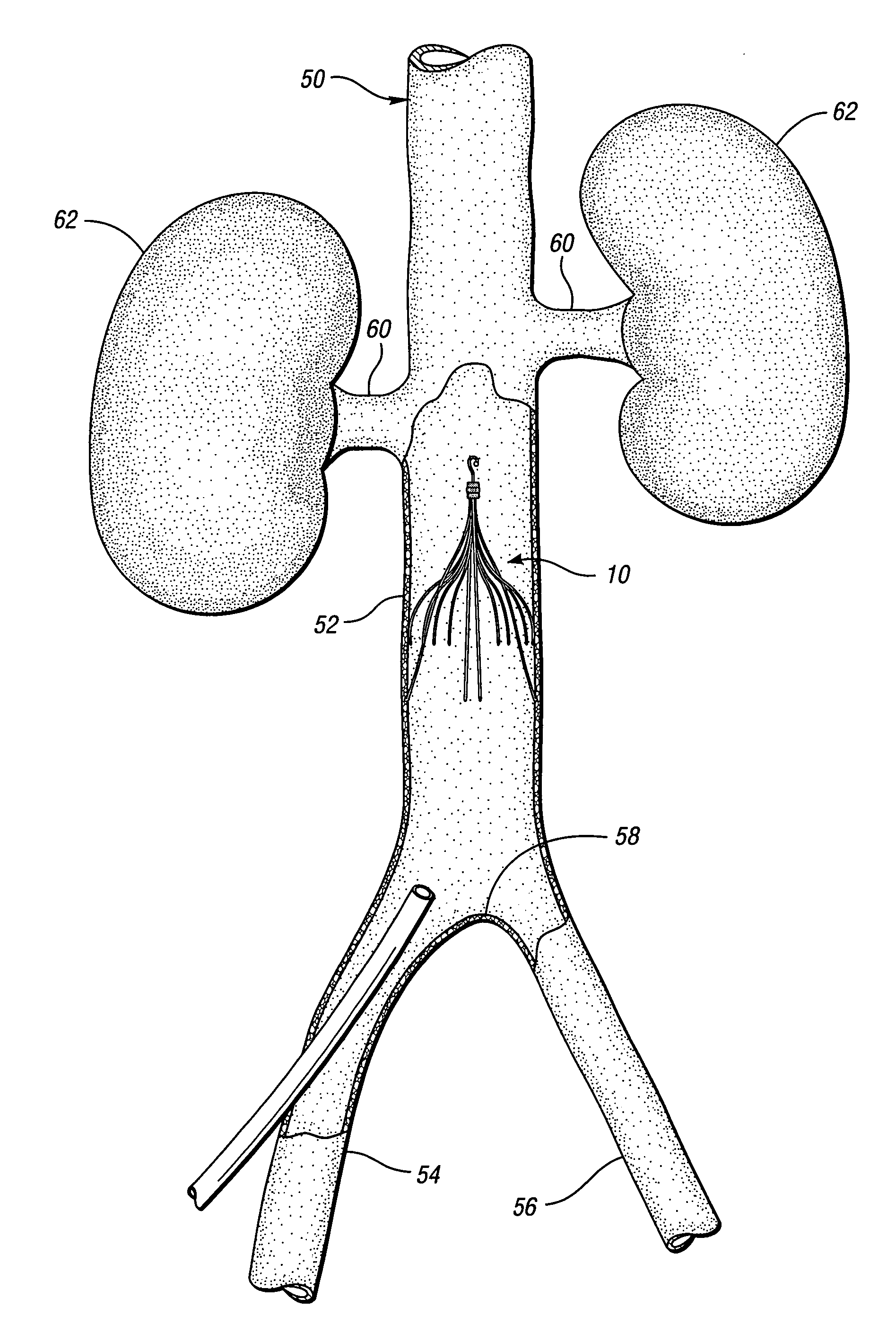 Removable vena cava filter comprising struts having axial bends