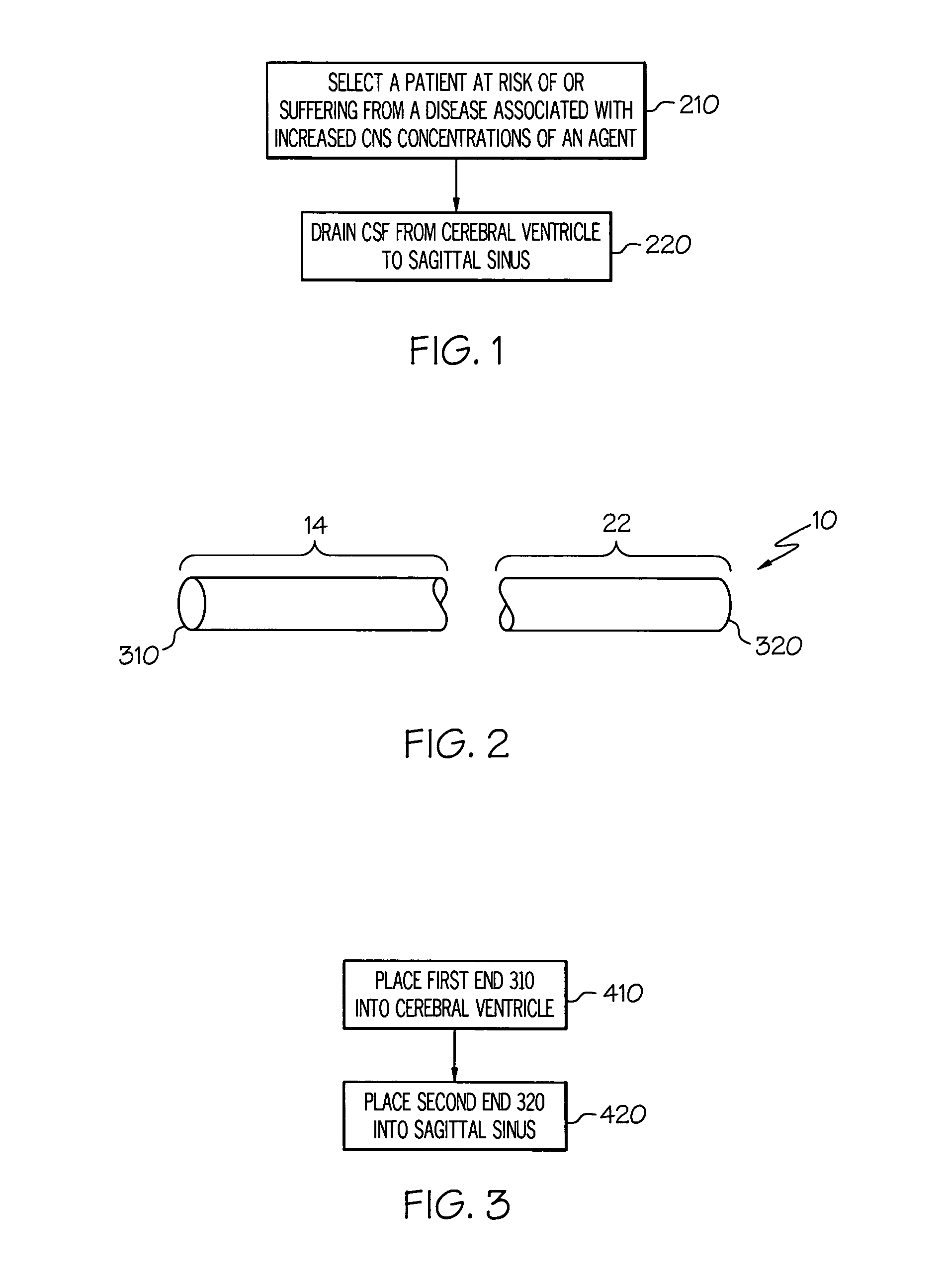 Ventriculo-sinus shunting for disease treatment