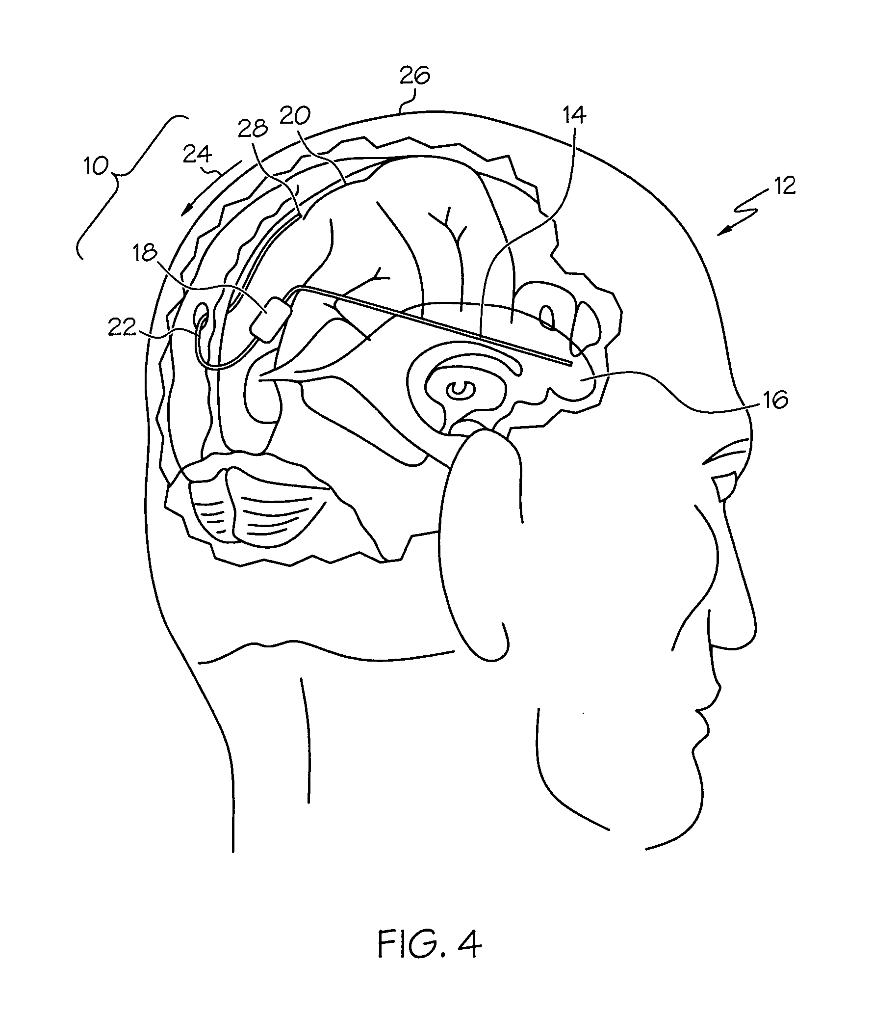 Ventriculo-sinus shunting for disease treatment