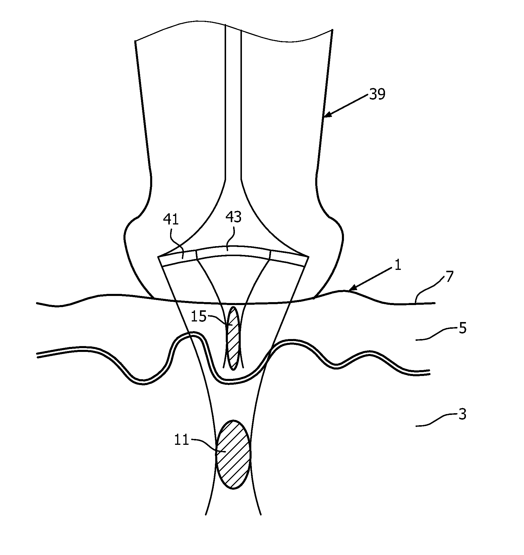 Skin treatment method and apparatus