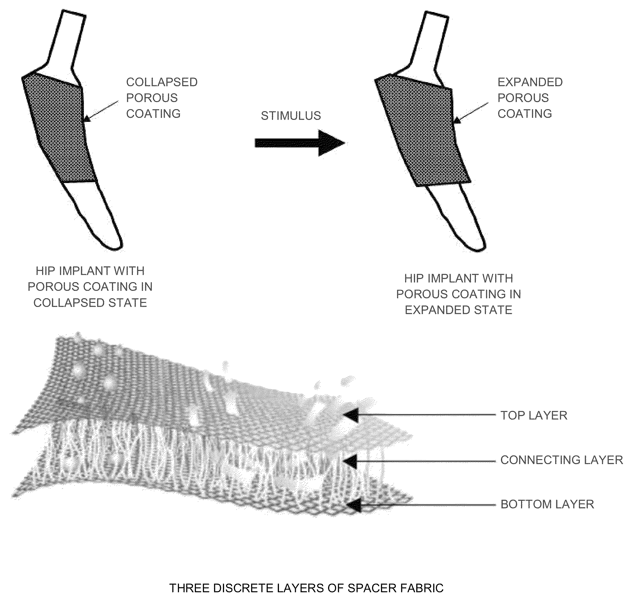 Dynamic porous coating for orthopedic implant