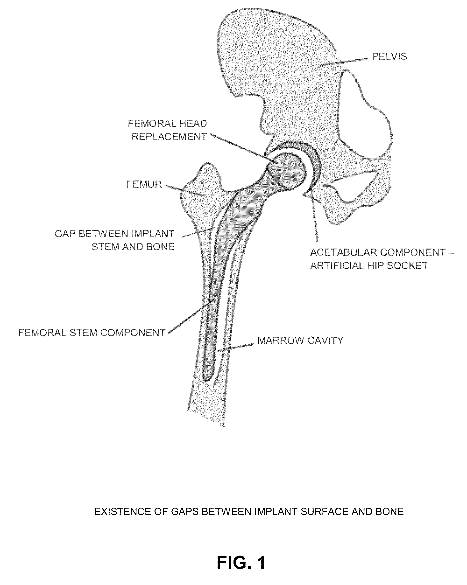 Dynamic porous coating for orthopedic implant