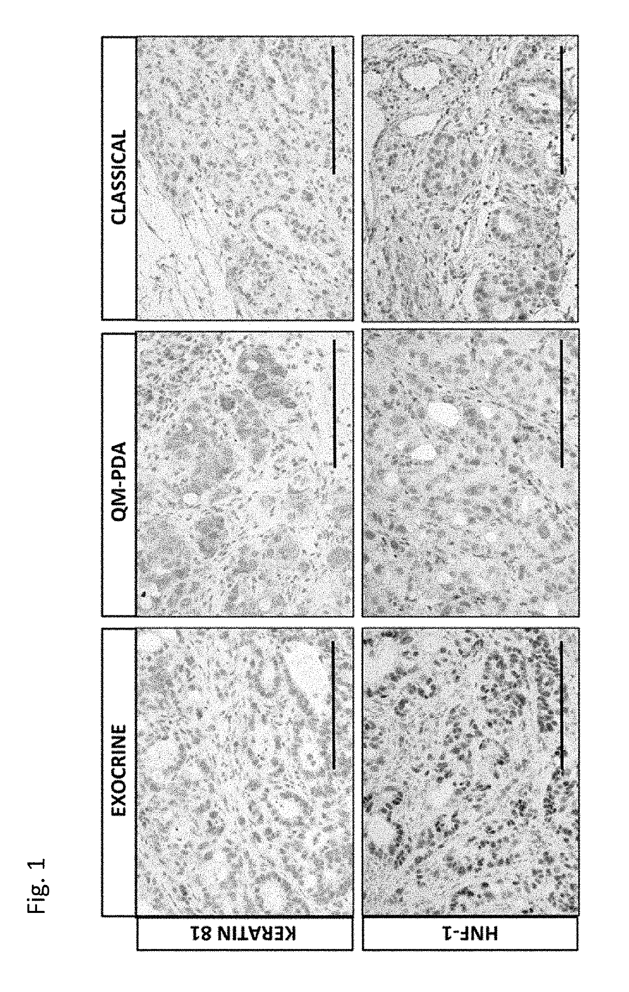 Novel Biomarkers for Sub-Typing Pancreatic Ductal Adenocarcinoma