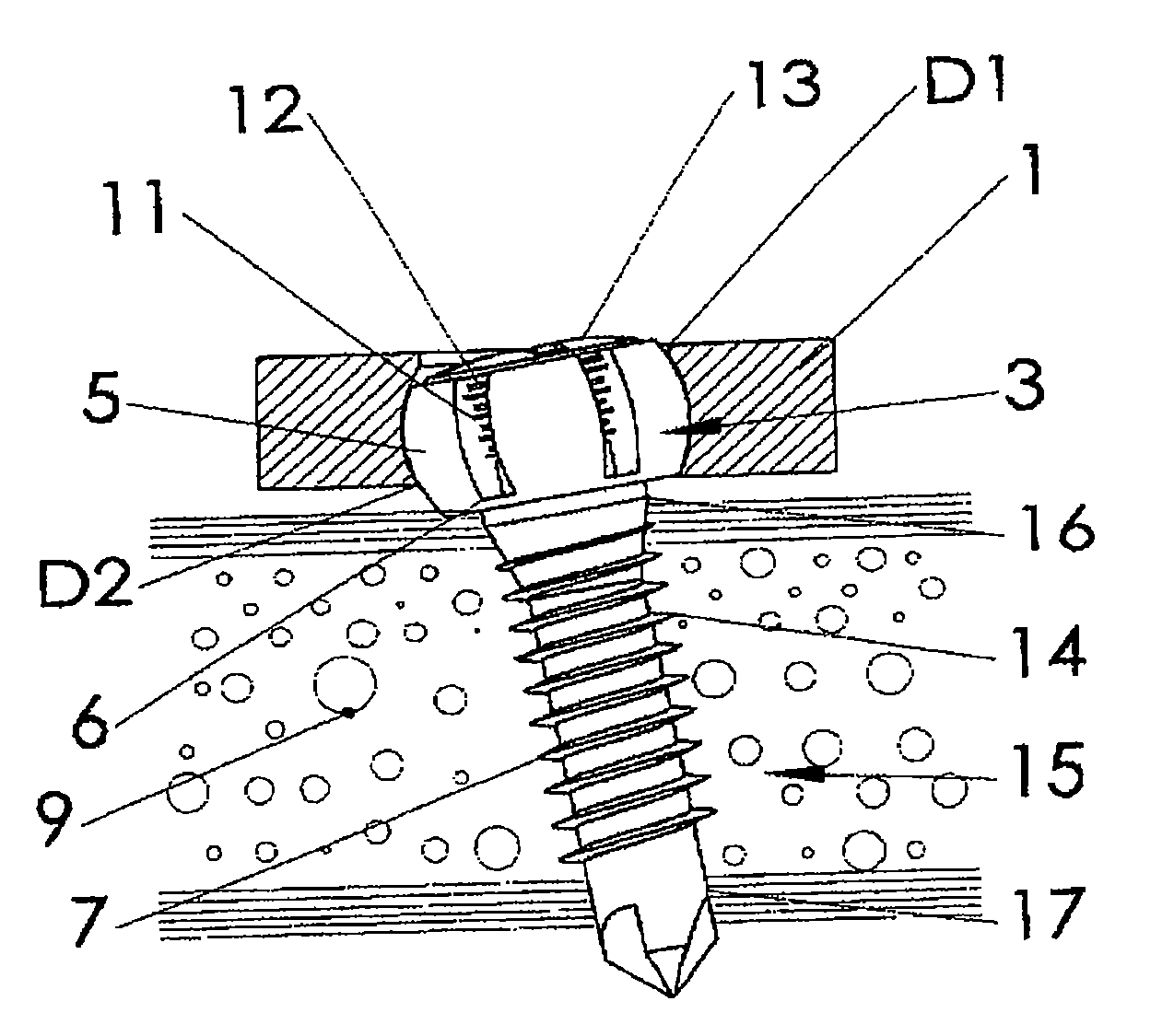 Bone fixation assembly