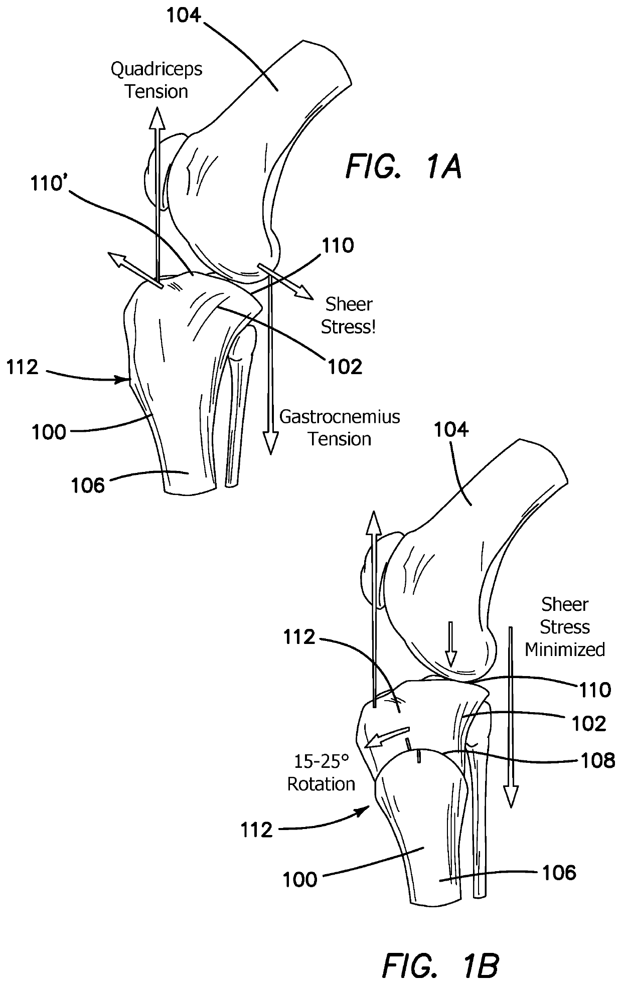 Method and Apparatus for Treating Cranial Cruciate Ligament Disease in Canines