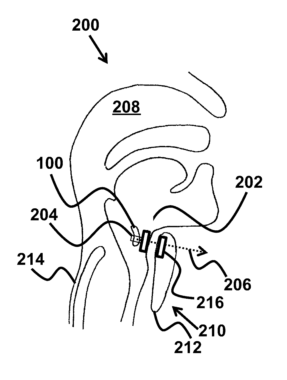 Device and method for correcting obstructive sleep apnea