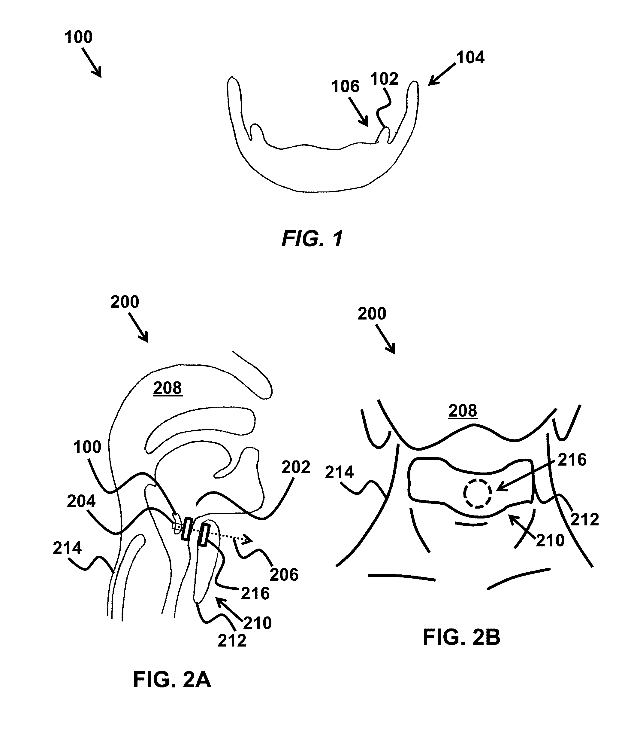 Device and method for correcting obstructive sleep apnea