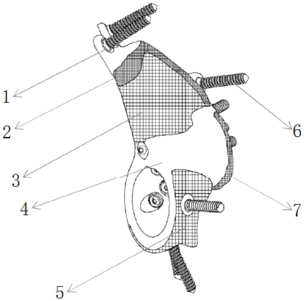 Individualized pelvic prosthesis